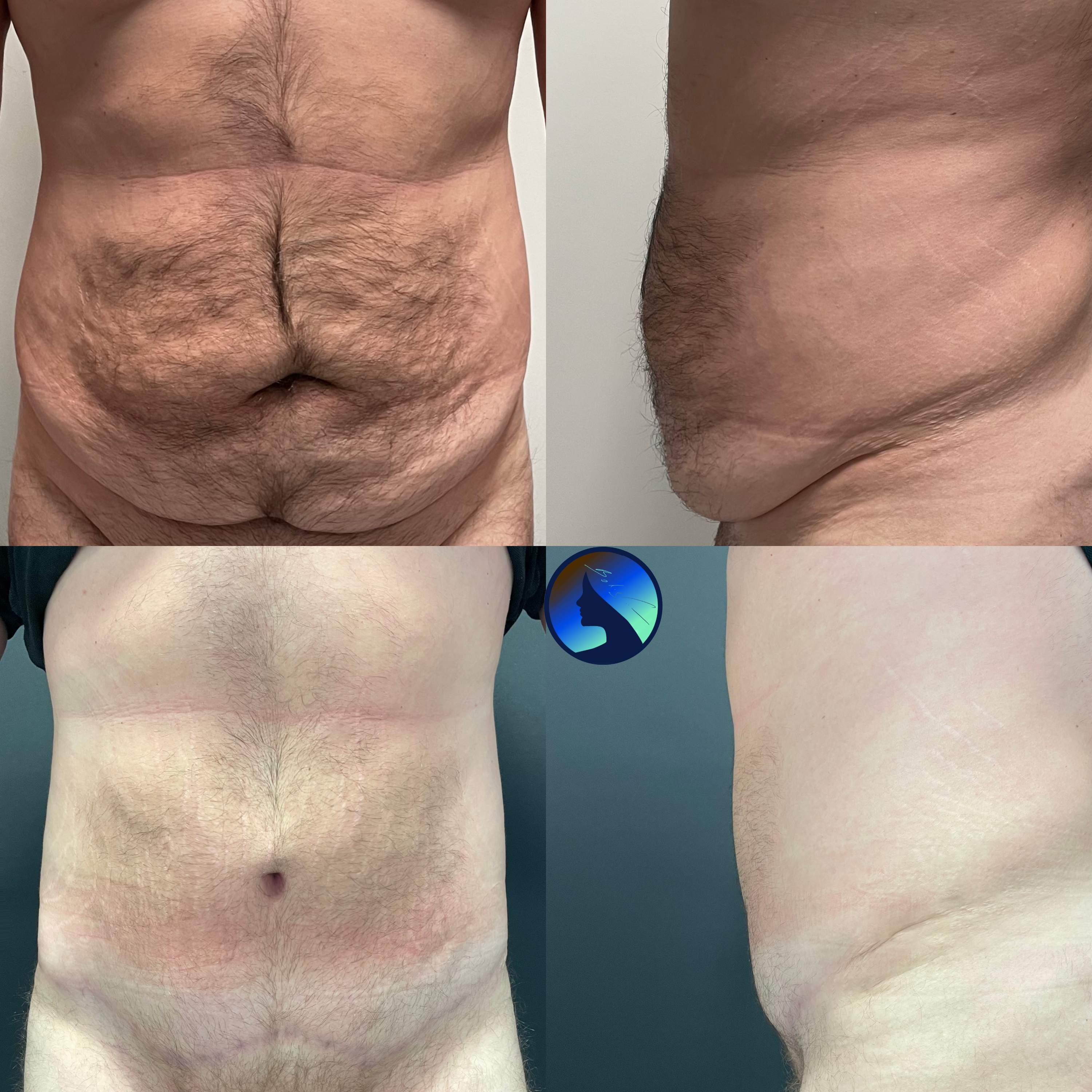 Abdominoplastik