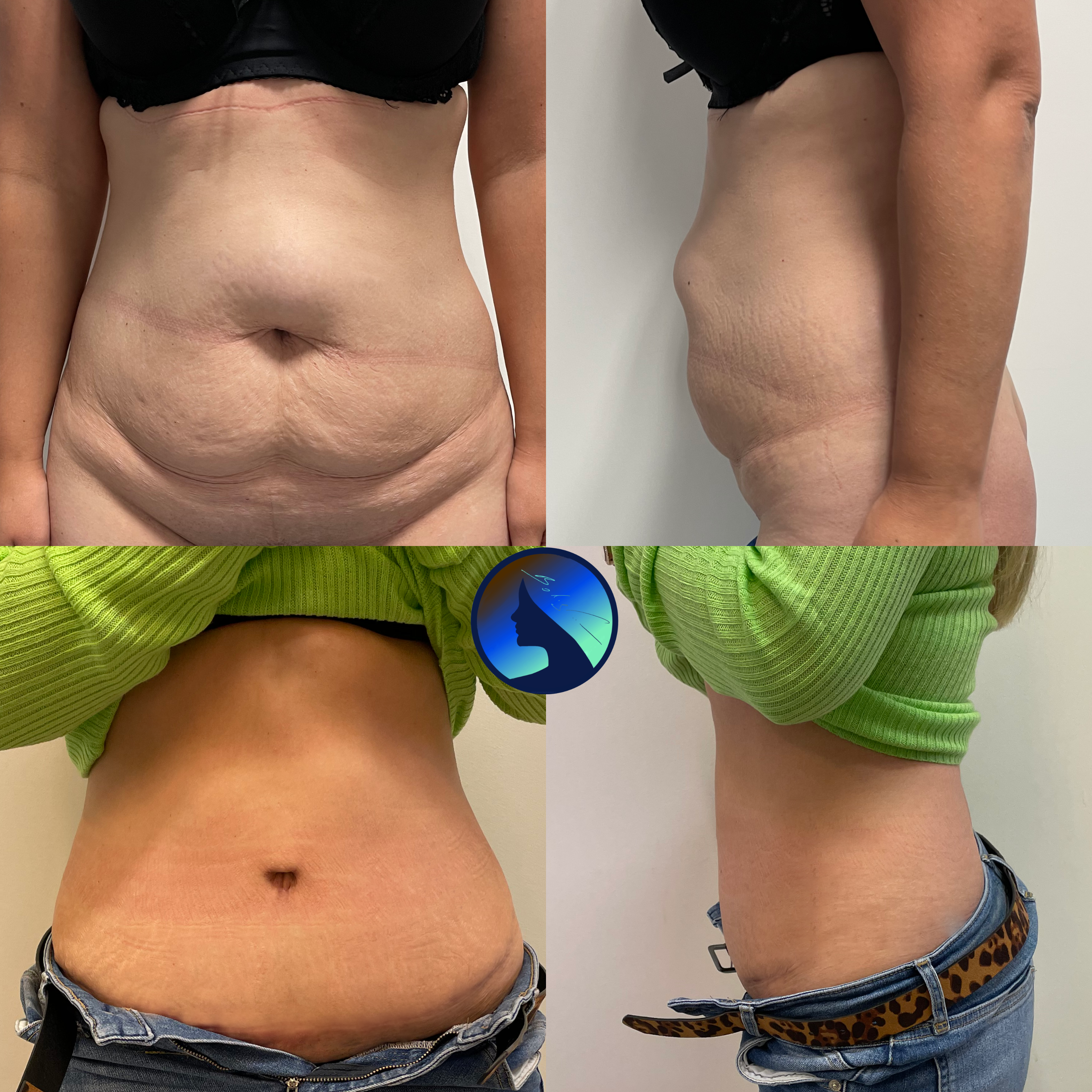 Abdominoplastyka z Hernioplastyką