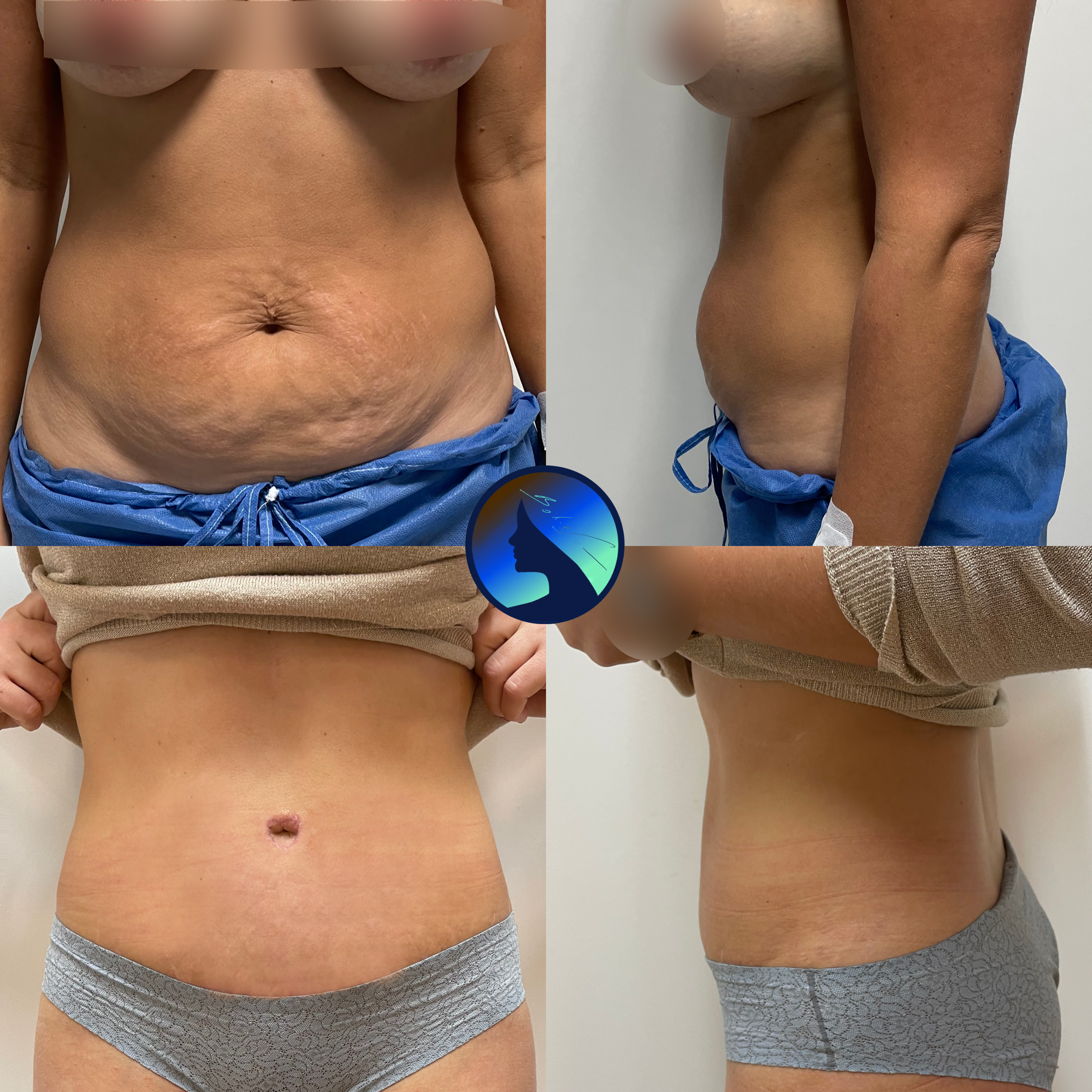 Abdominoplastyka