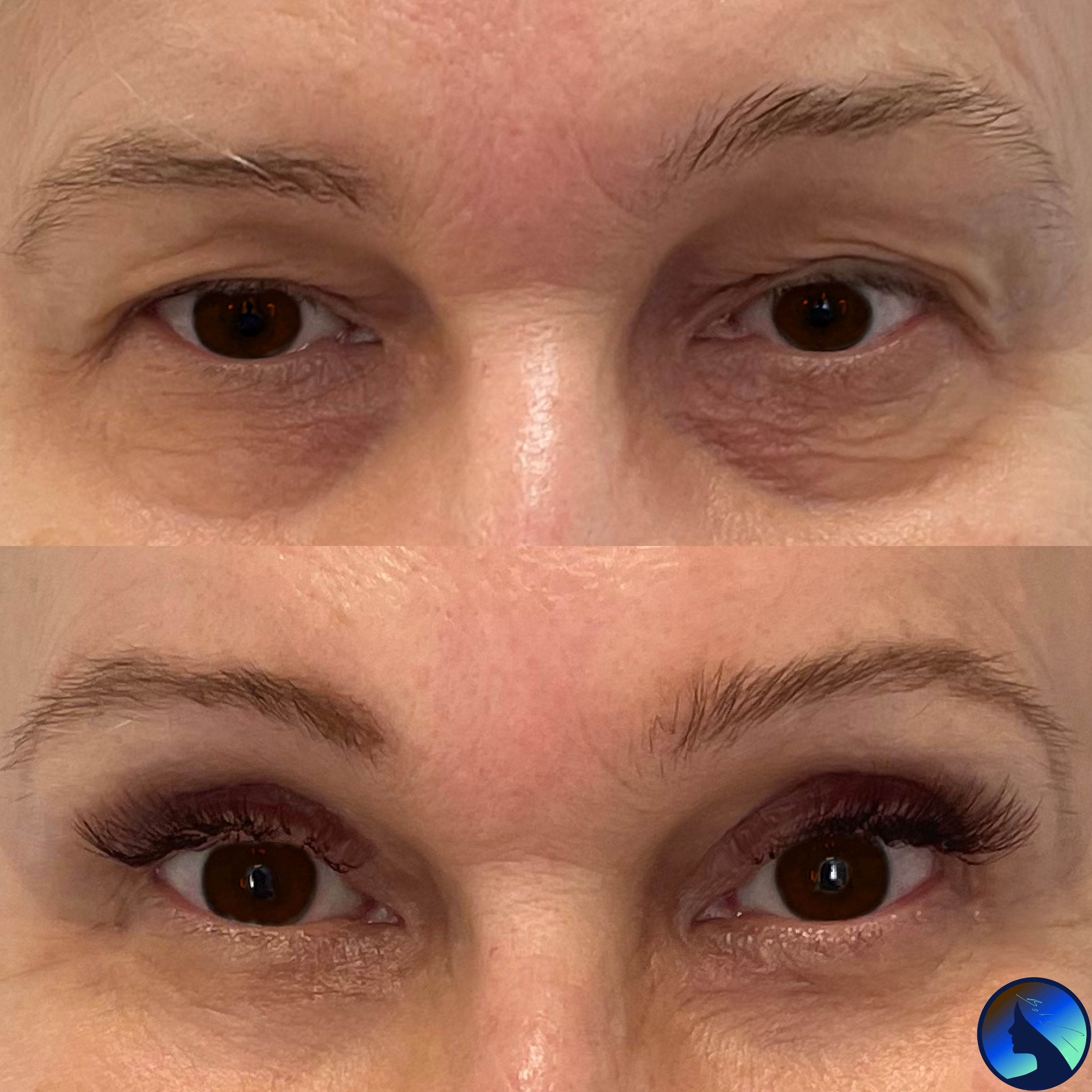 Amazing Blepharoplasty