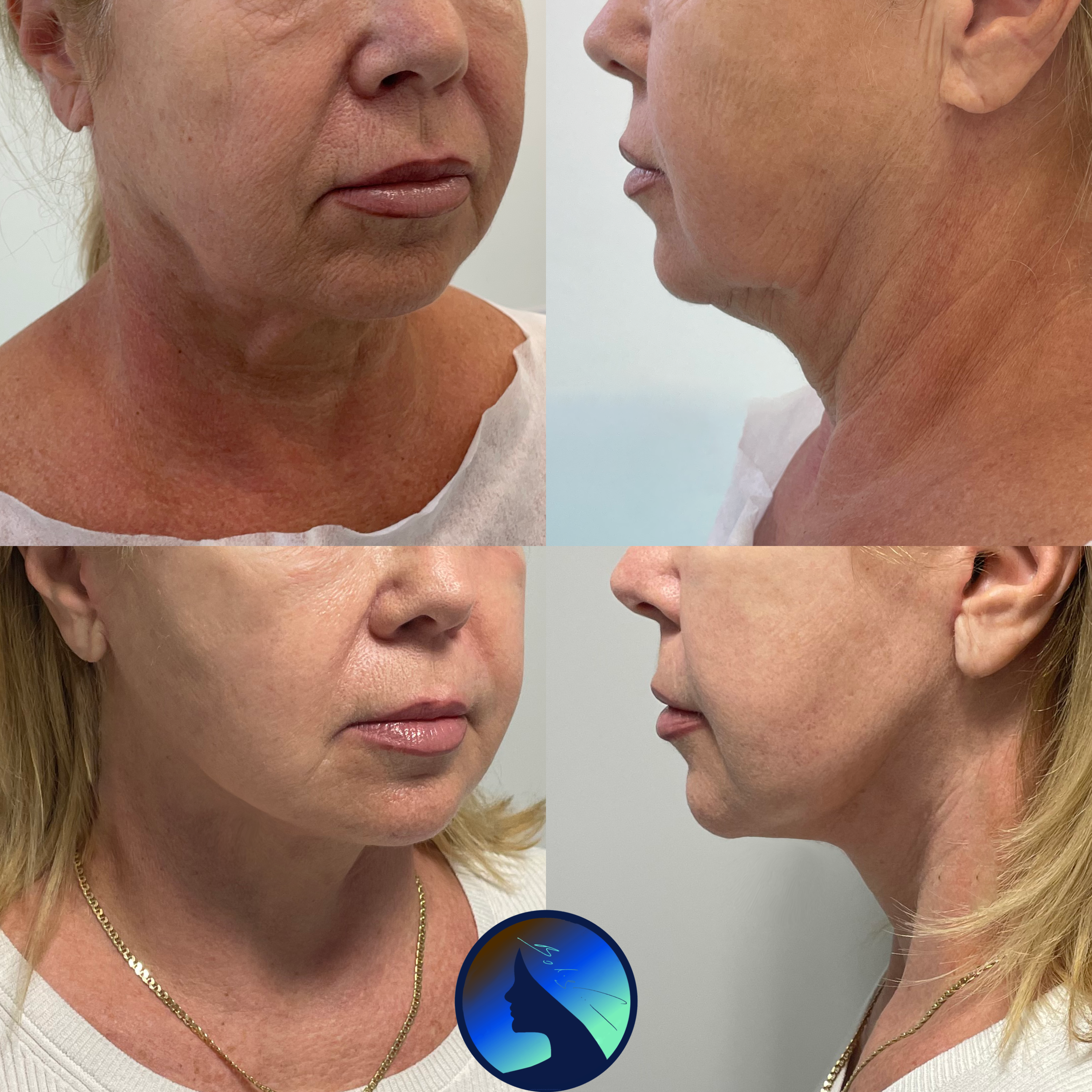 American Face- and Necklift