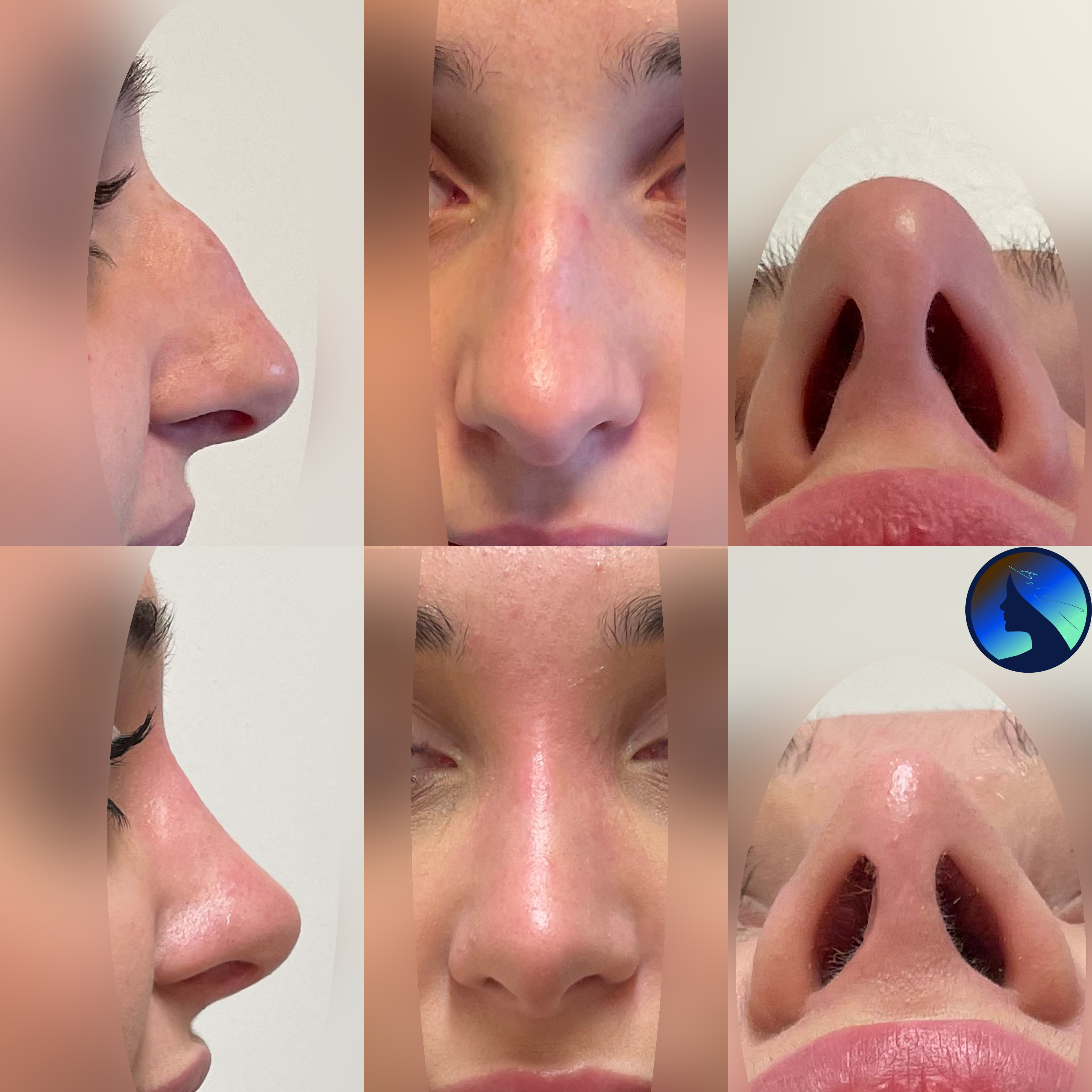 Beautiful Rhinoplasty