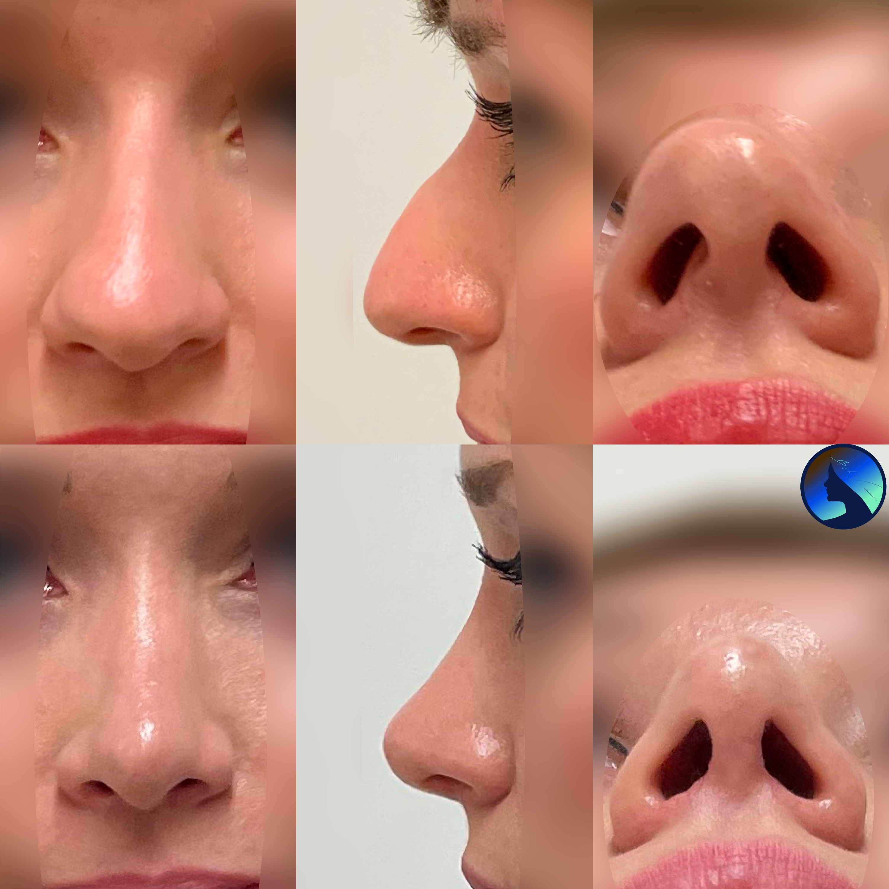 Beautiful Septorhinoplasty