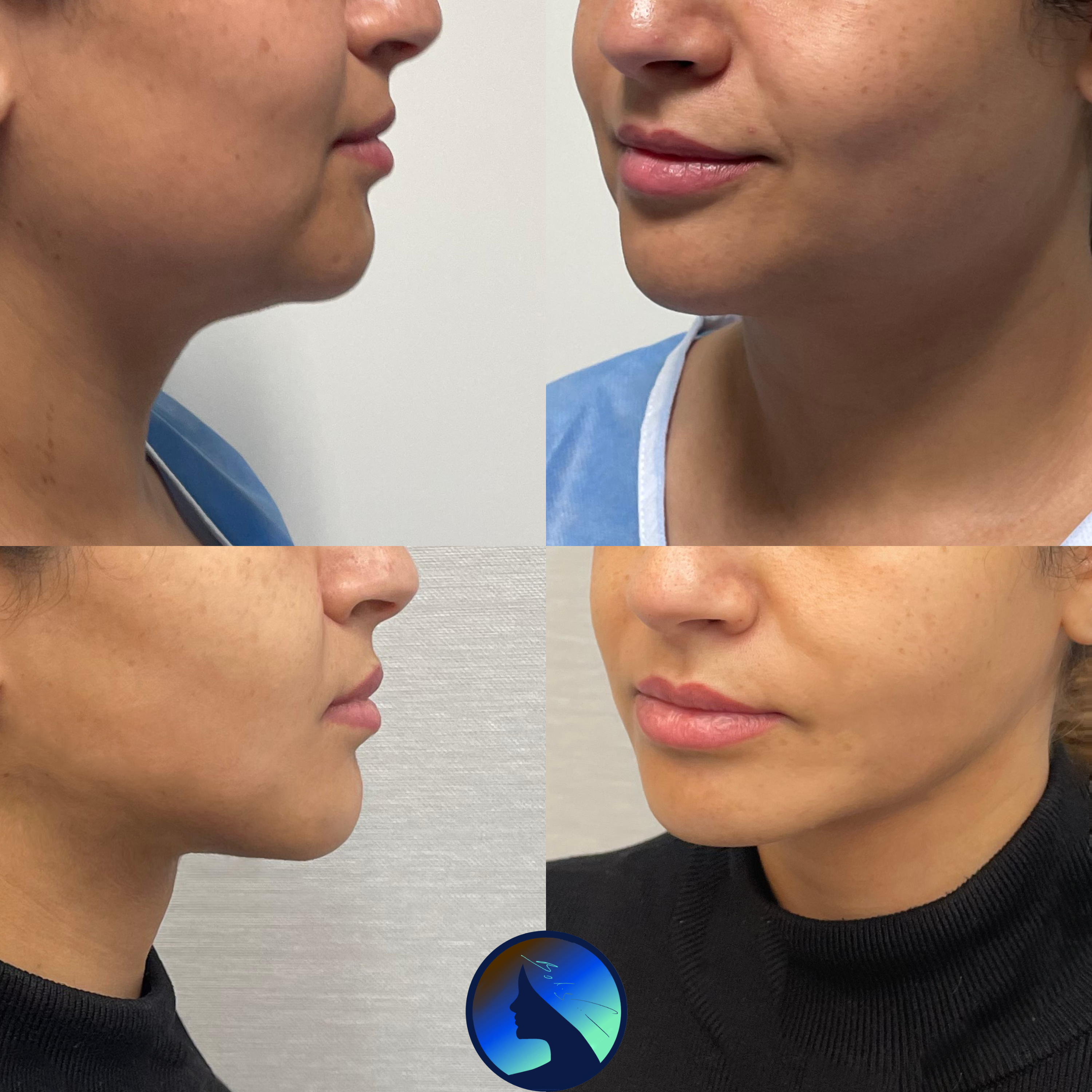 Bichektomia z liposukcją podbródka