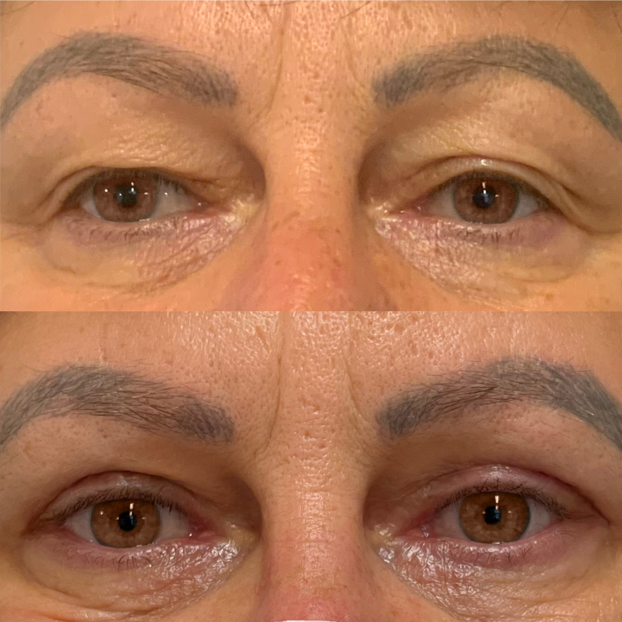 Blefaroplastyka
