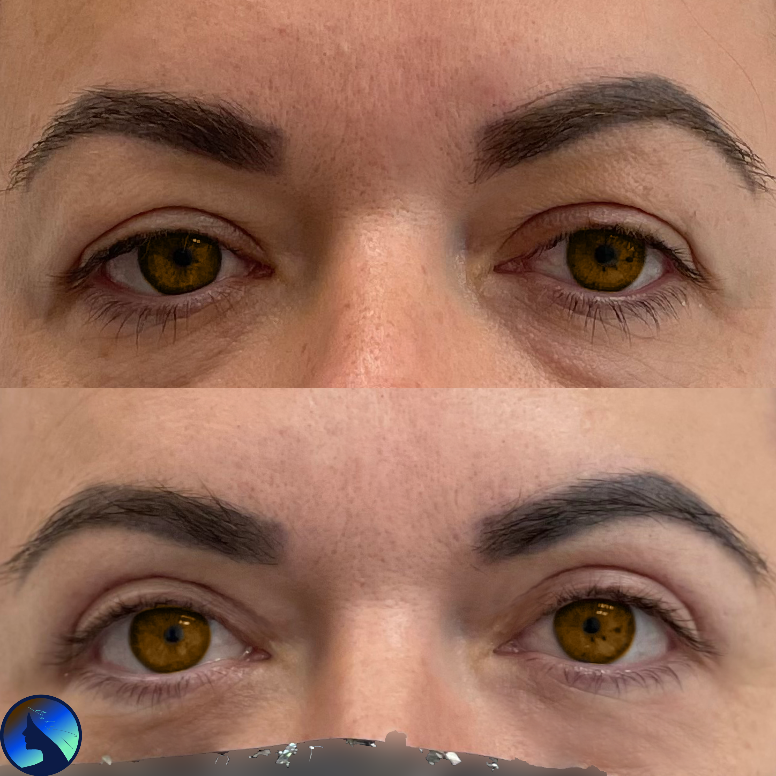 Blepharoplasty in middle age