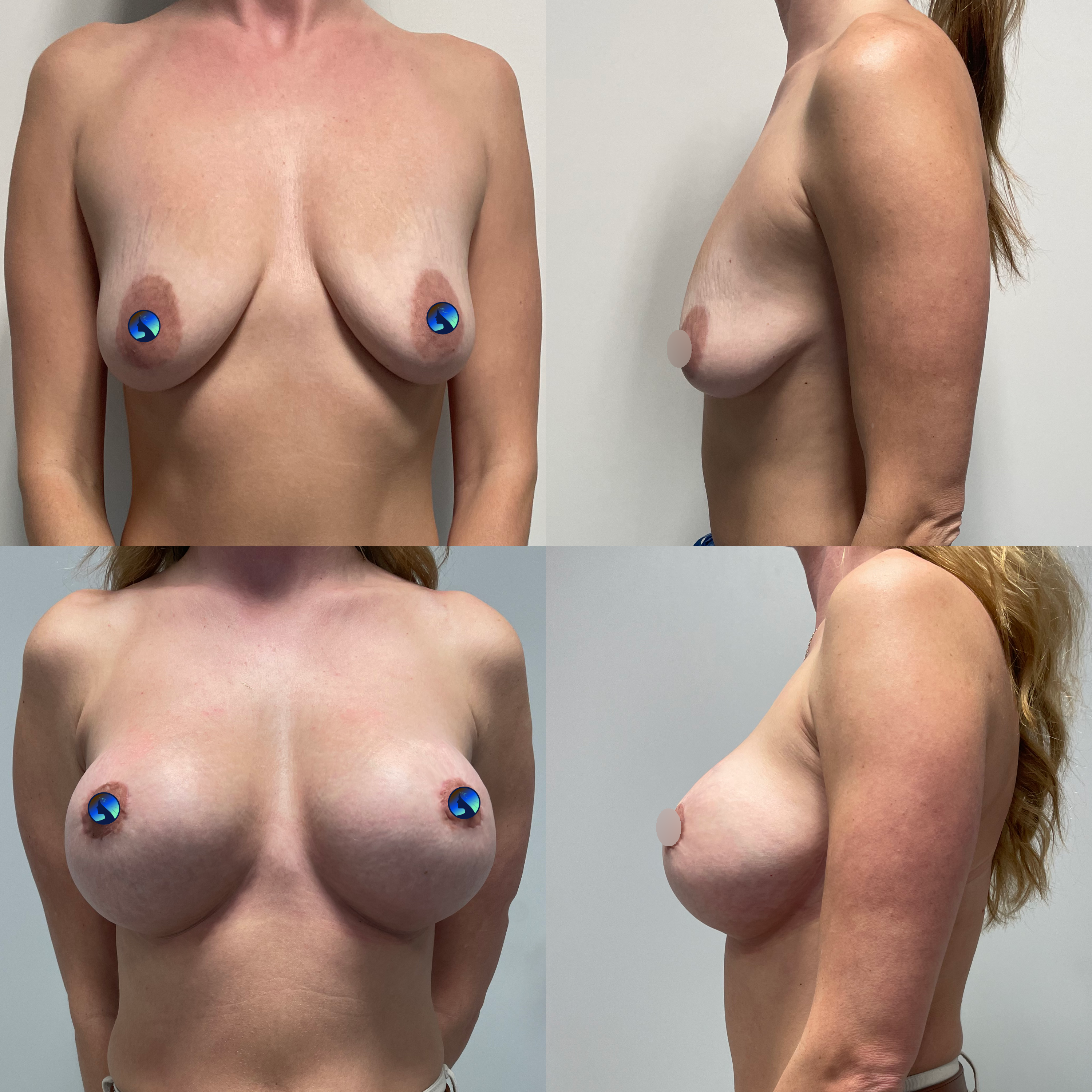 Breasts after pregnancy