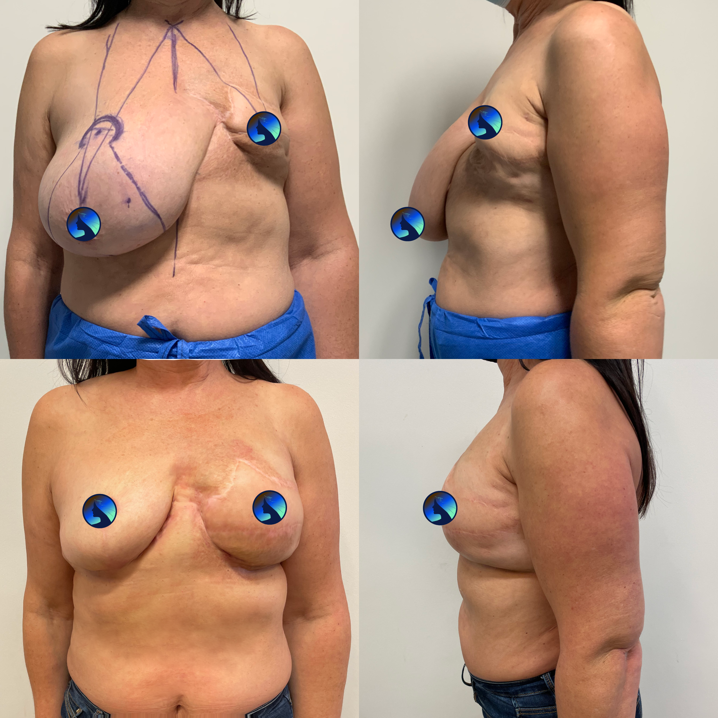 Breasts reconstruction special