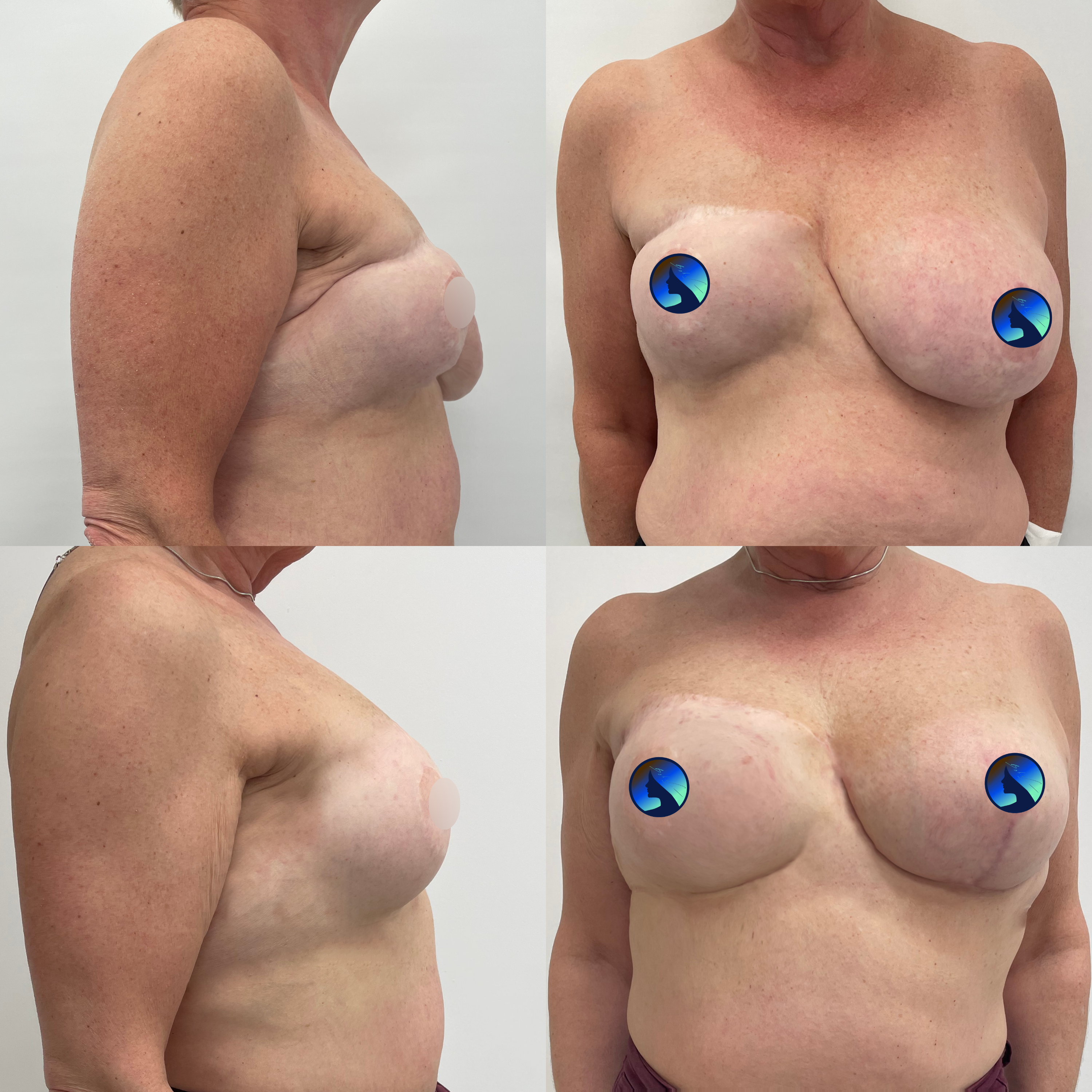 Breasts symmetrization after cancer