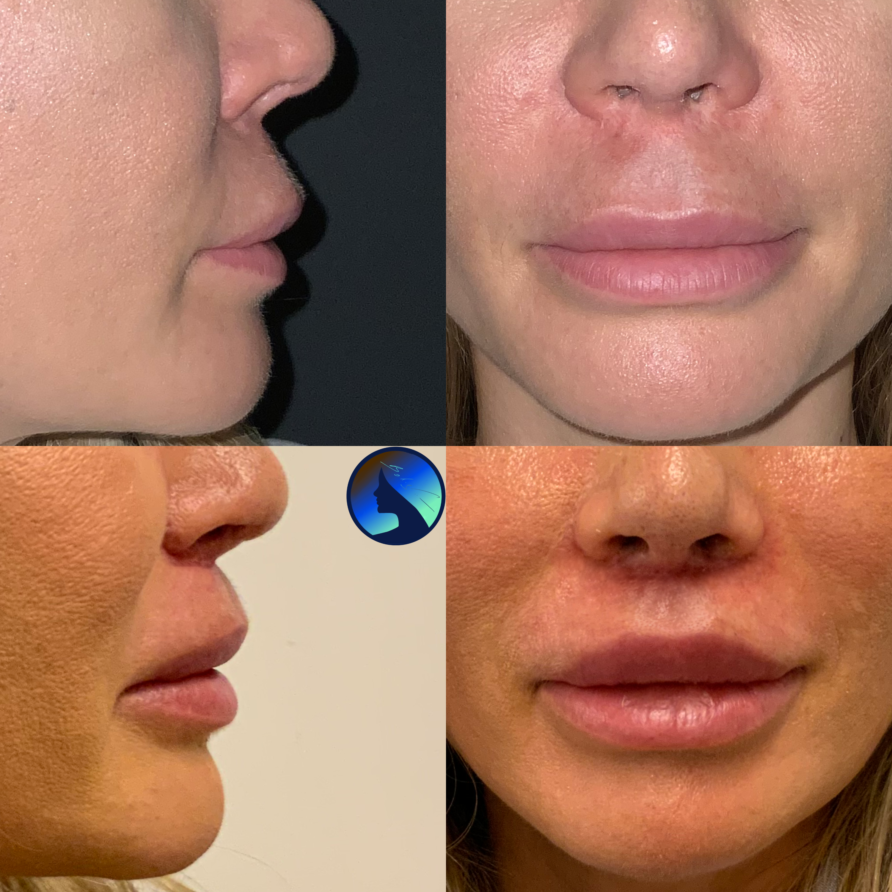 Bullhorn Lip Lift after Rhinoplasty