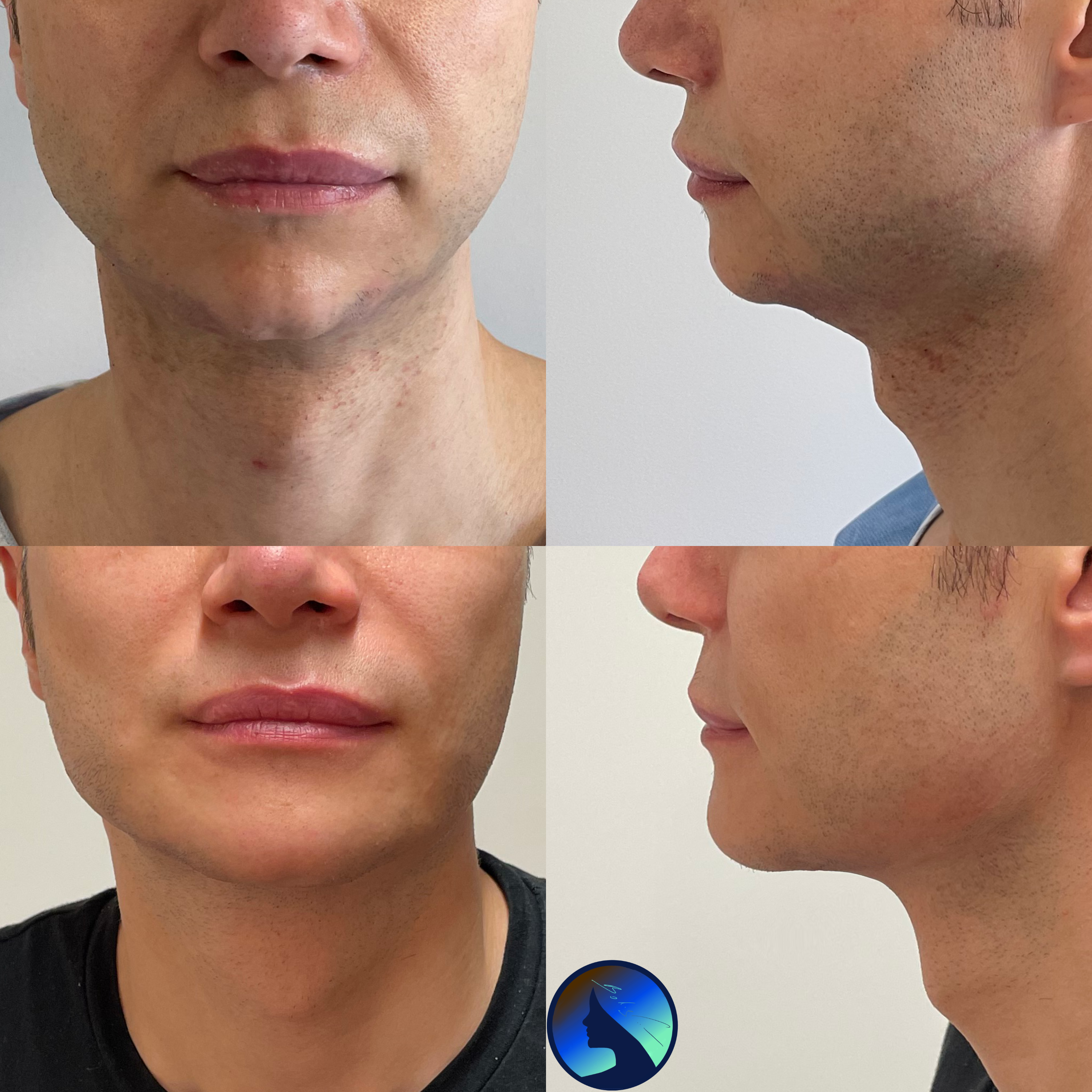 Chin implant, bichektomy, neck and jaw lipo