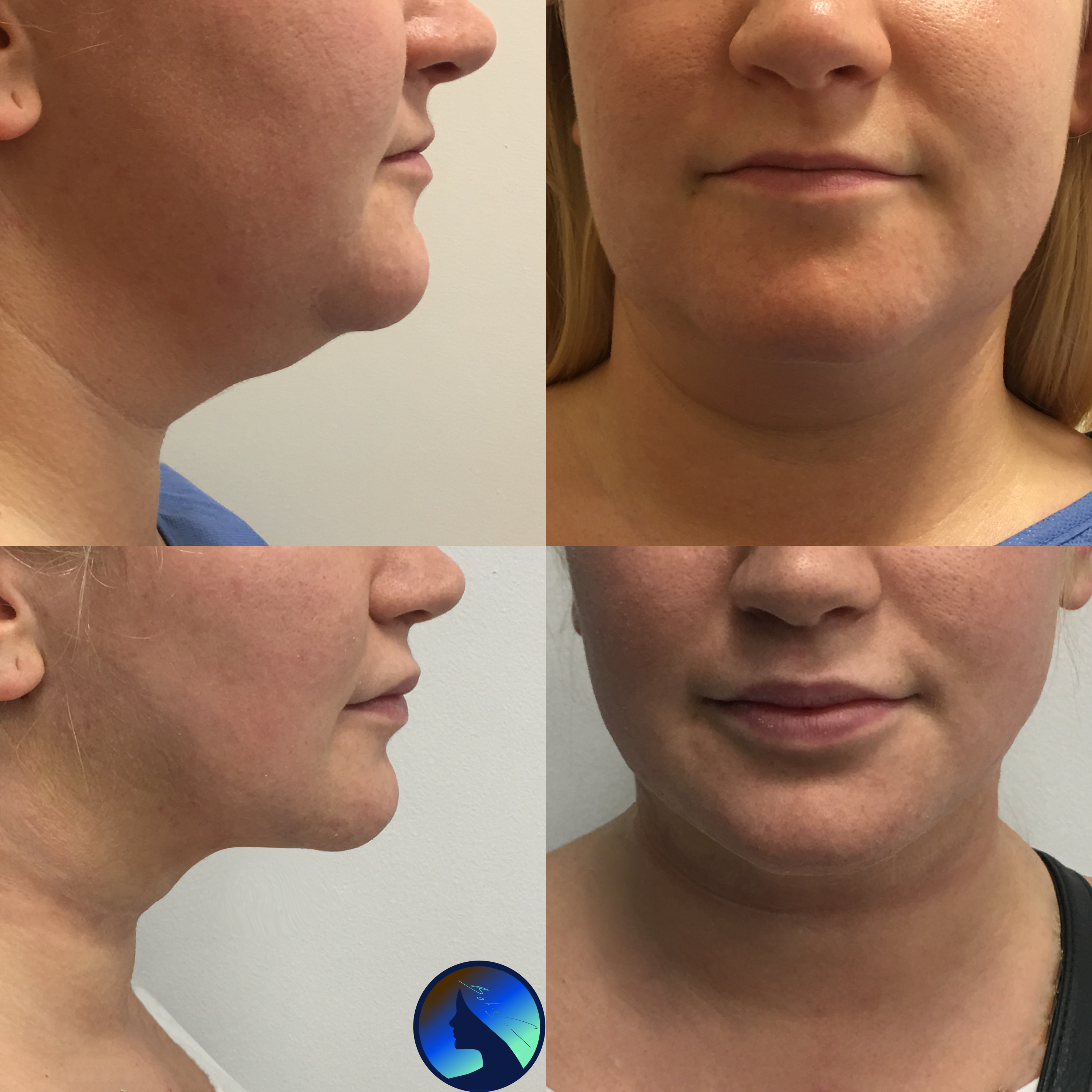 Chin lipo with lipotransfer to lips