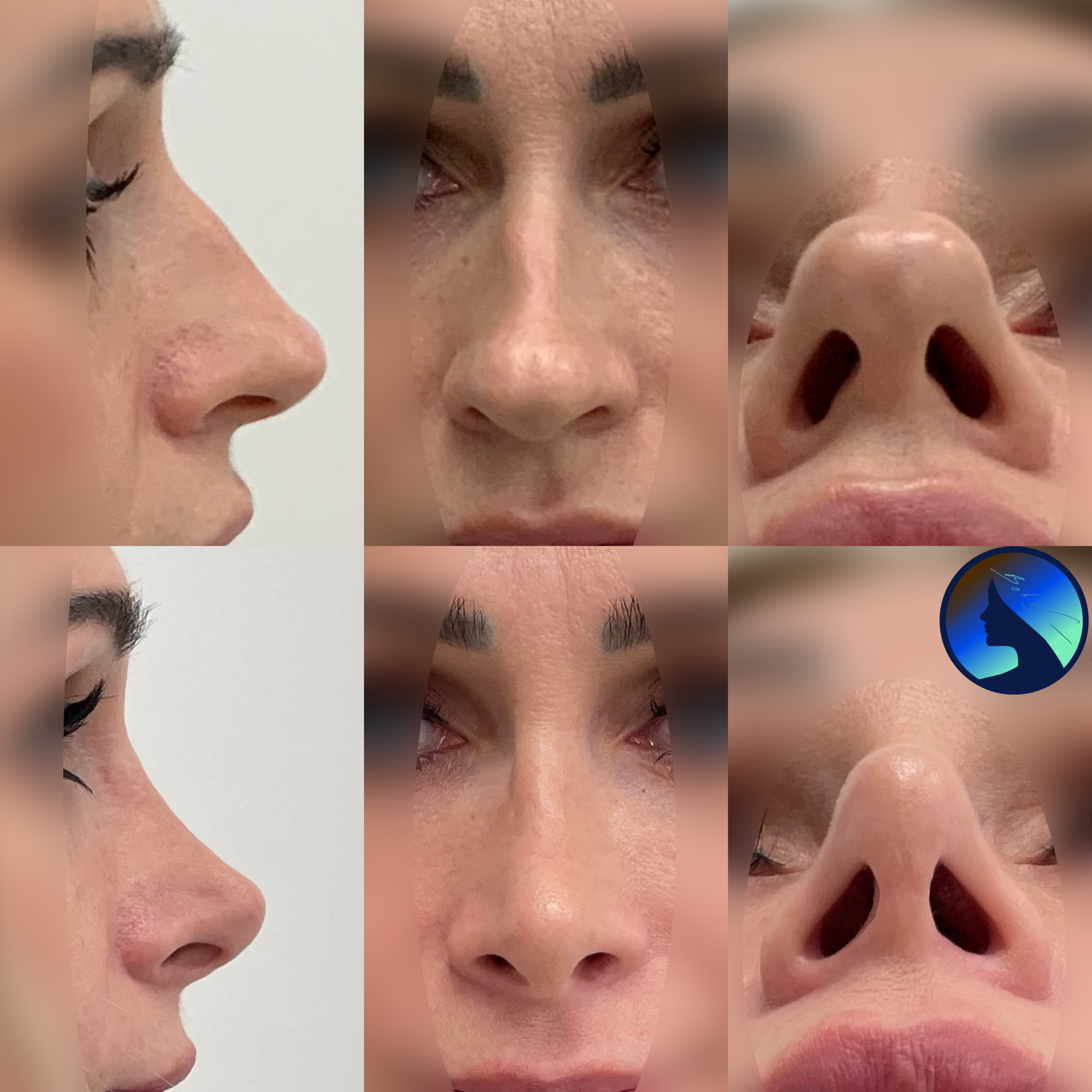 Classic Rhinoplasty