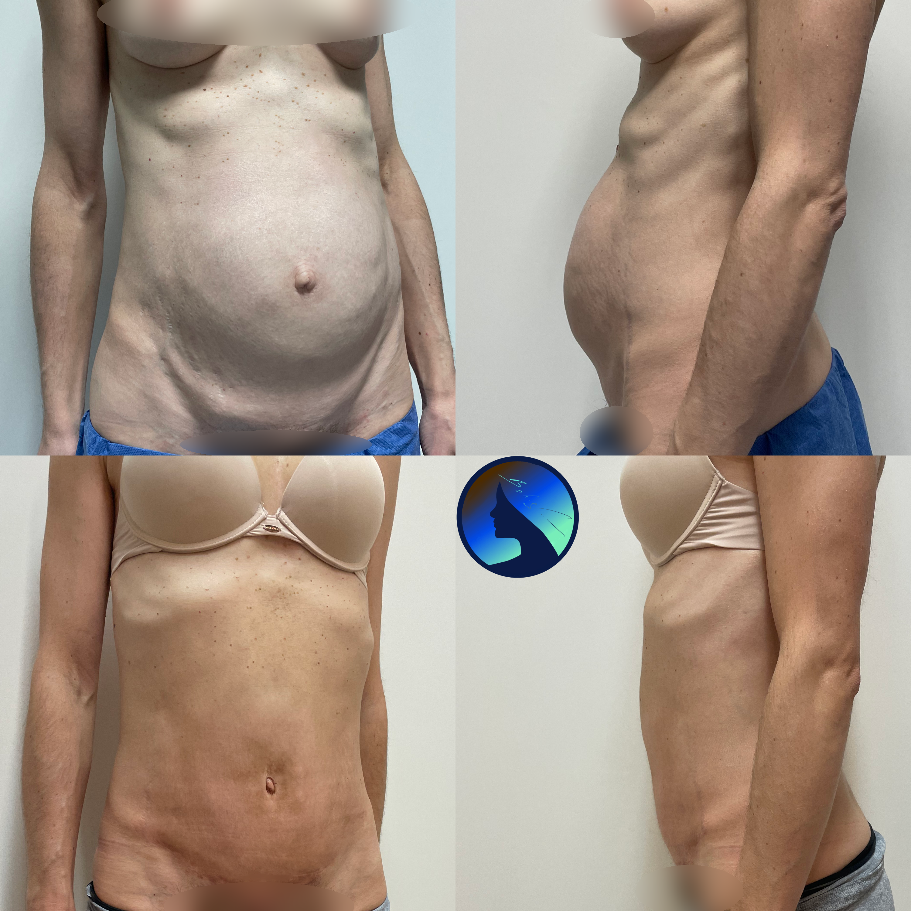 Component Separation after Ramirez