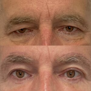 Direct Brow Lift + Midface Lift