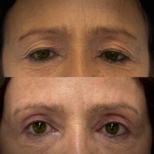 Direct Brow Lift with Blepharoplasty