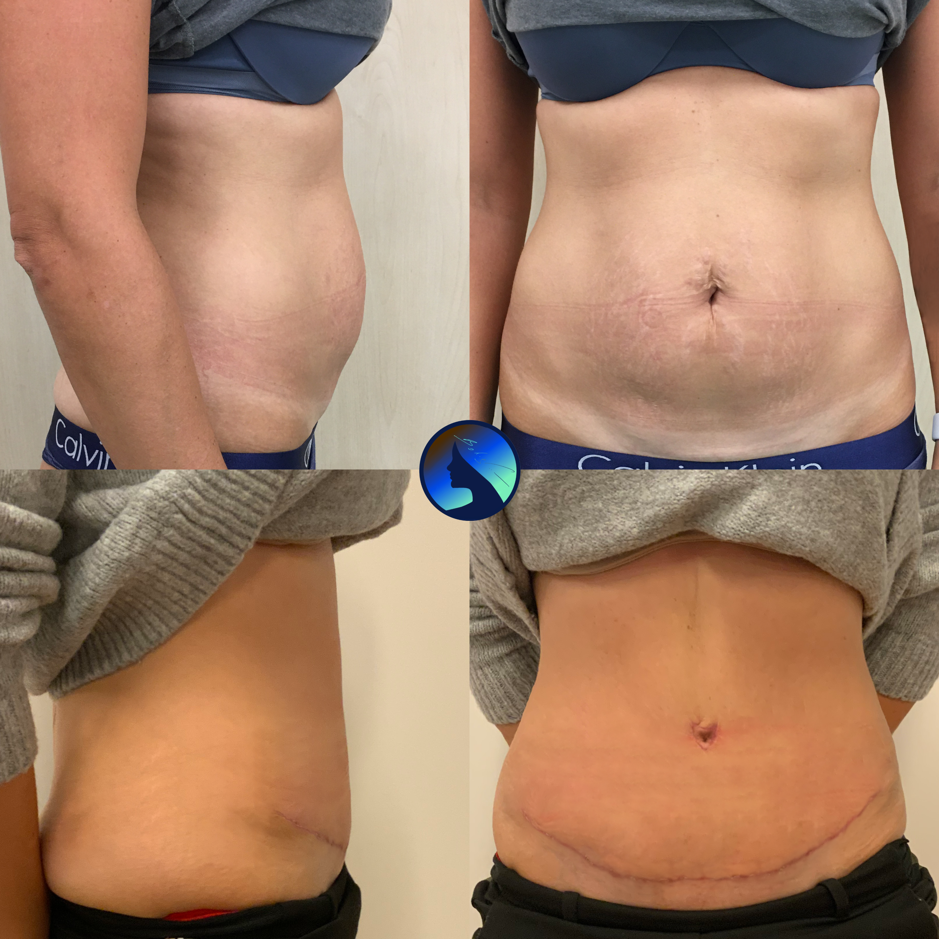 Fresh Abdominoplasty