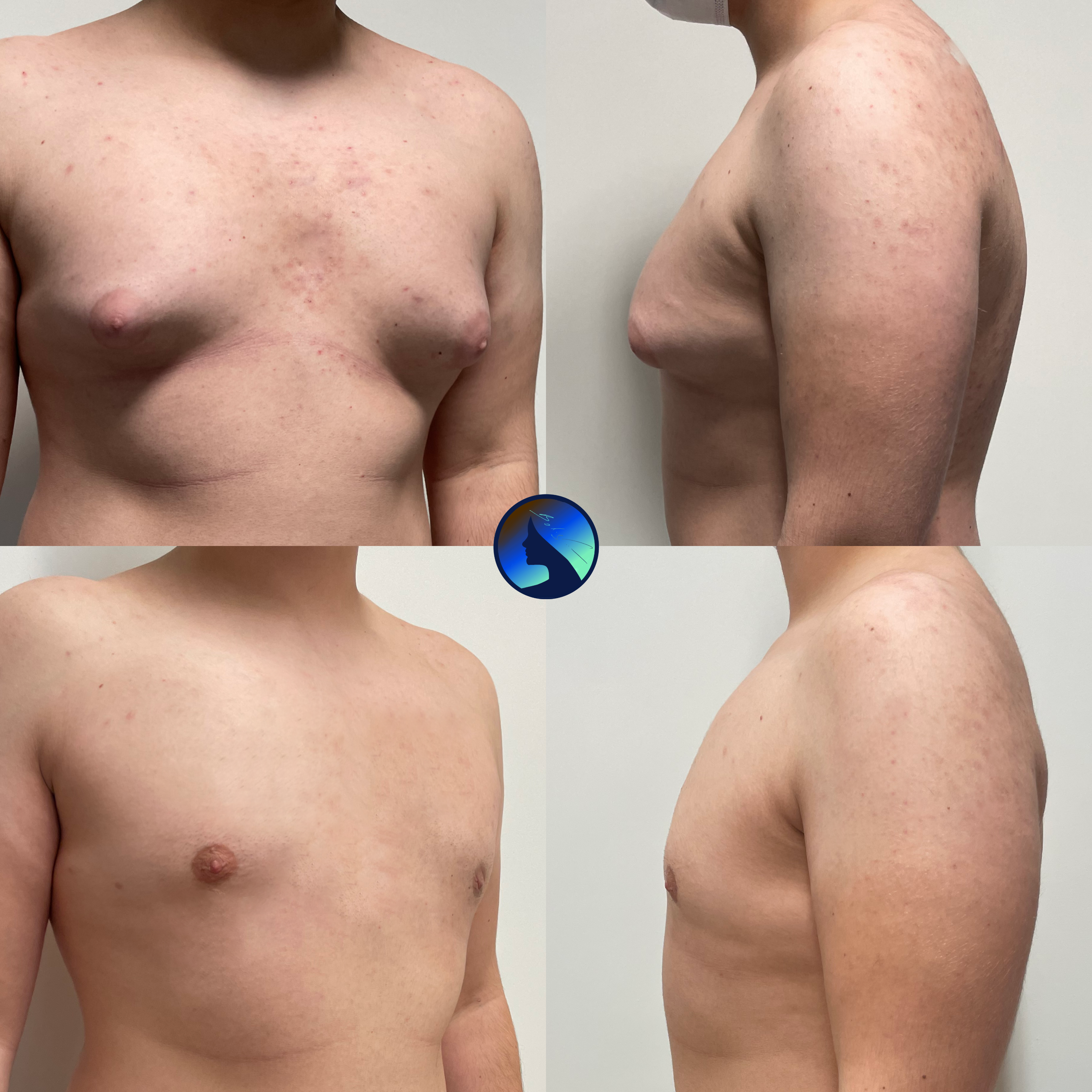 Ginekomastia Type II