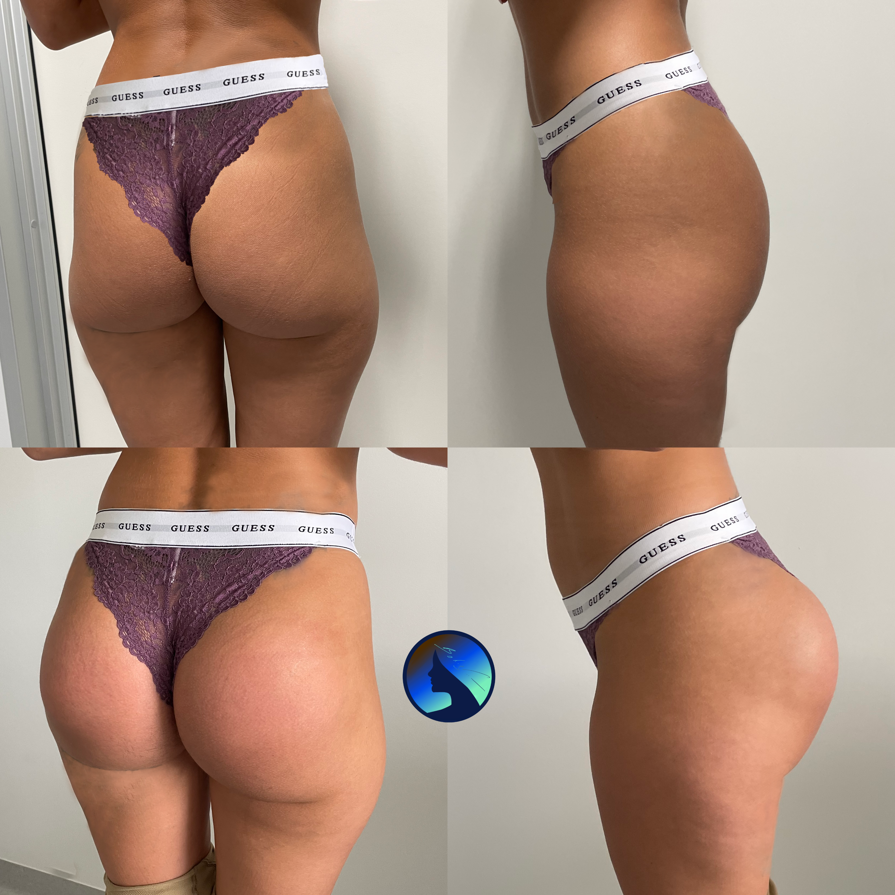 Implanty pośladków