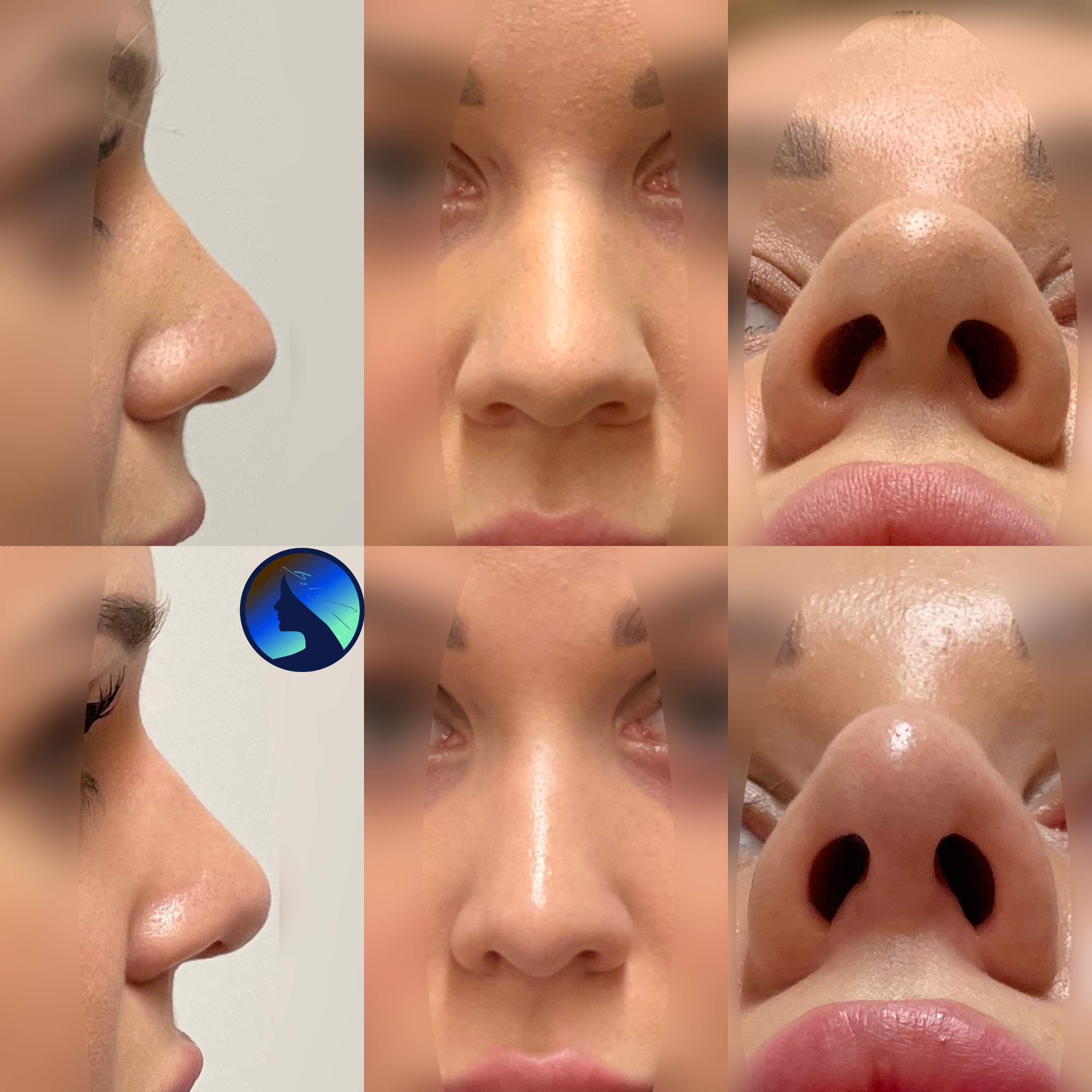 Wtórna korekta nosa