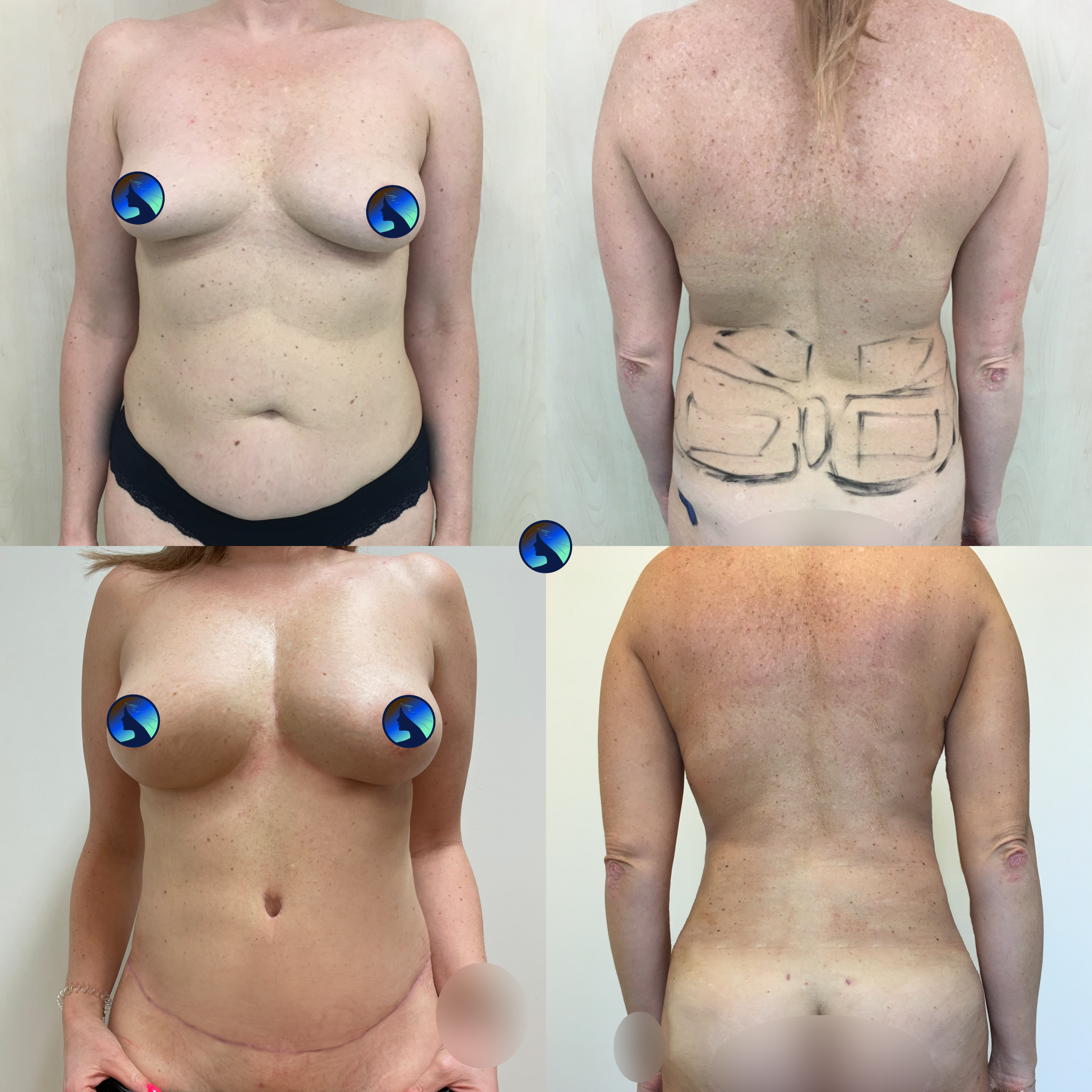 Lipoabdominoplasty and Lipotransfer