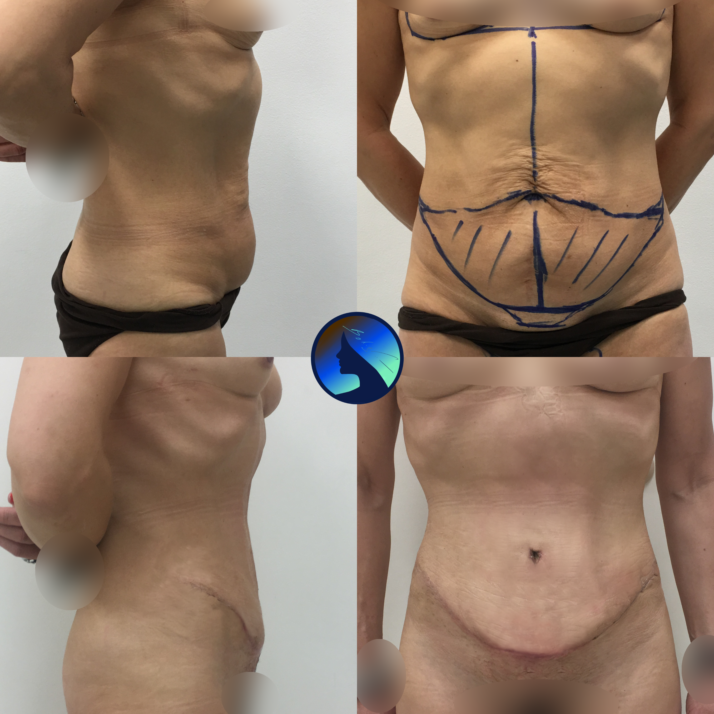 Lipoabdominoplasty