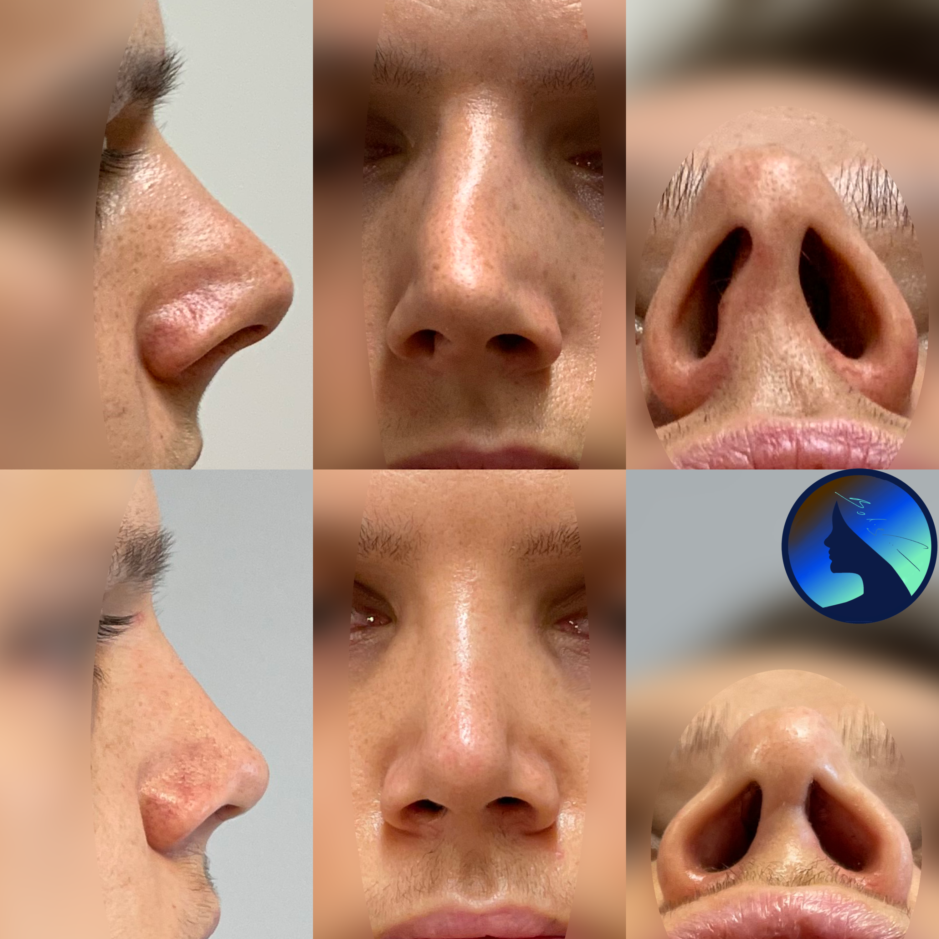 Male Rhinoplasty