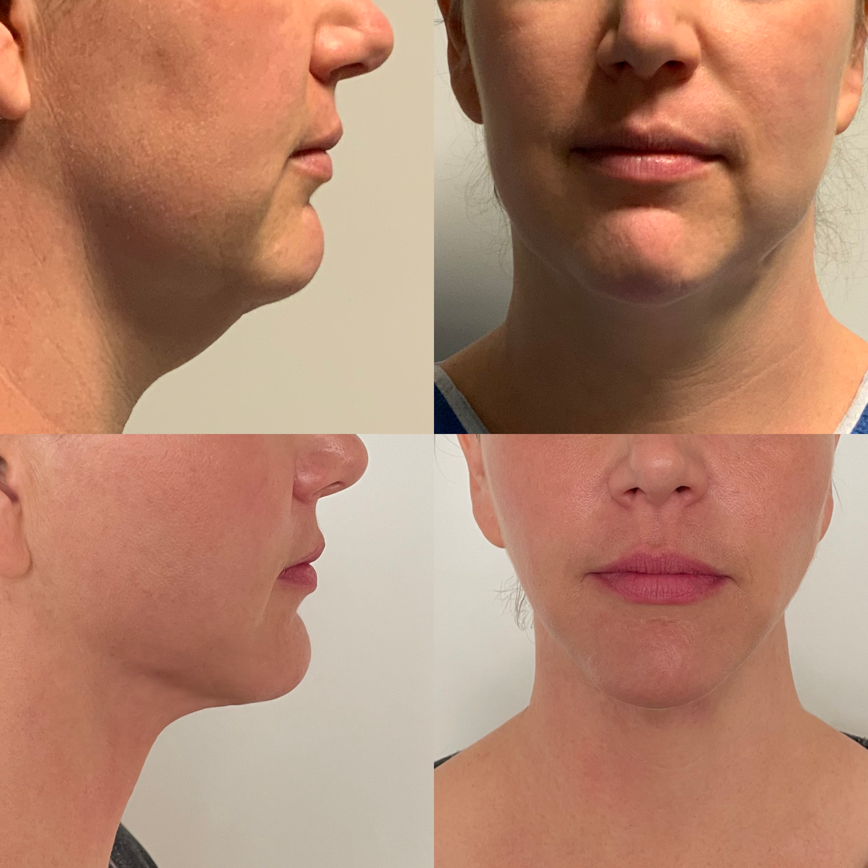 Neck Liposuction