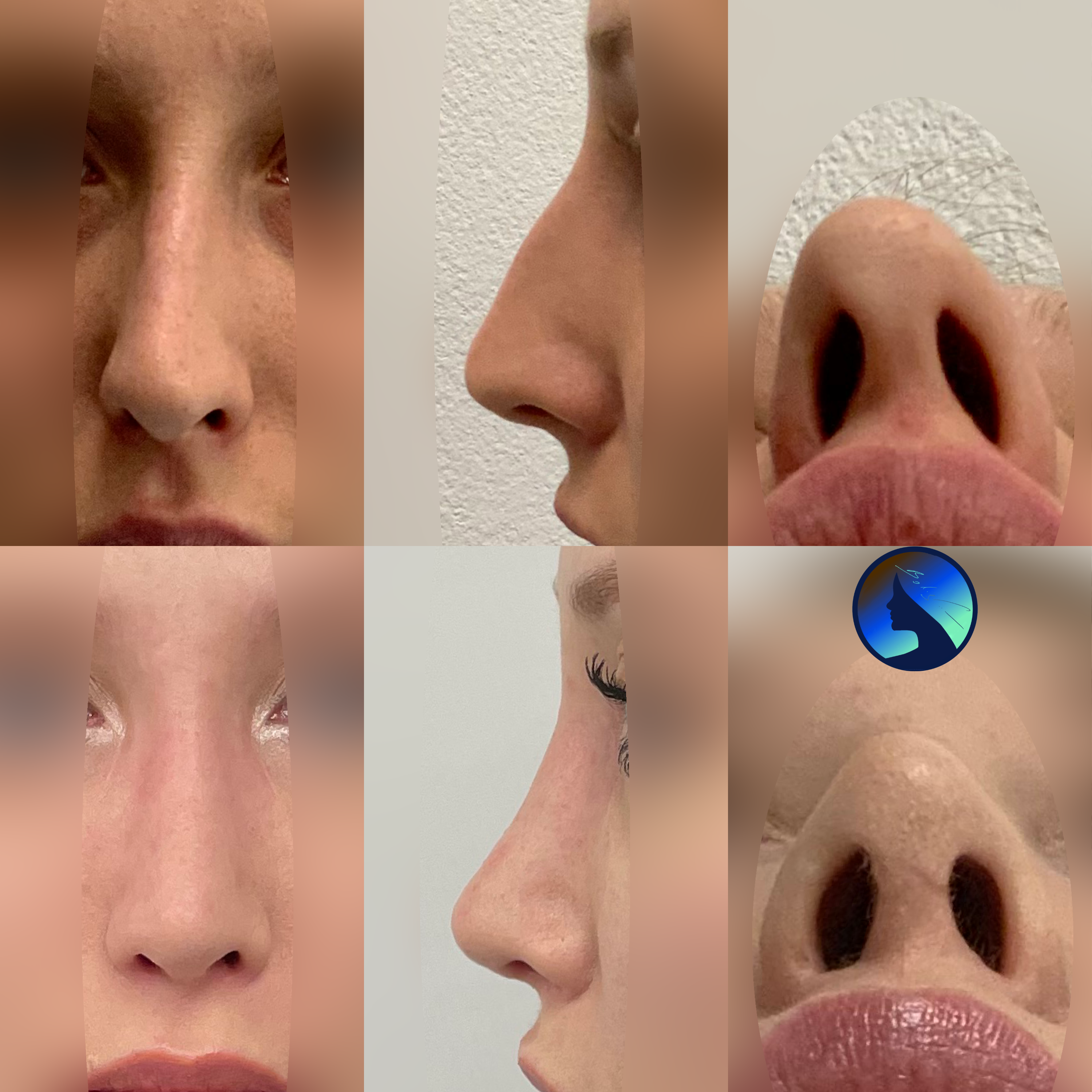 Nose Job by Boliglowa Bromba’s technique