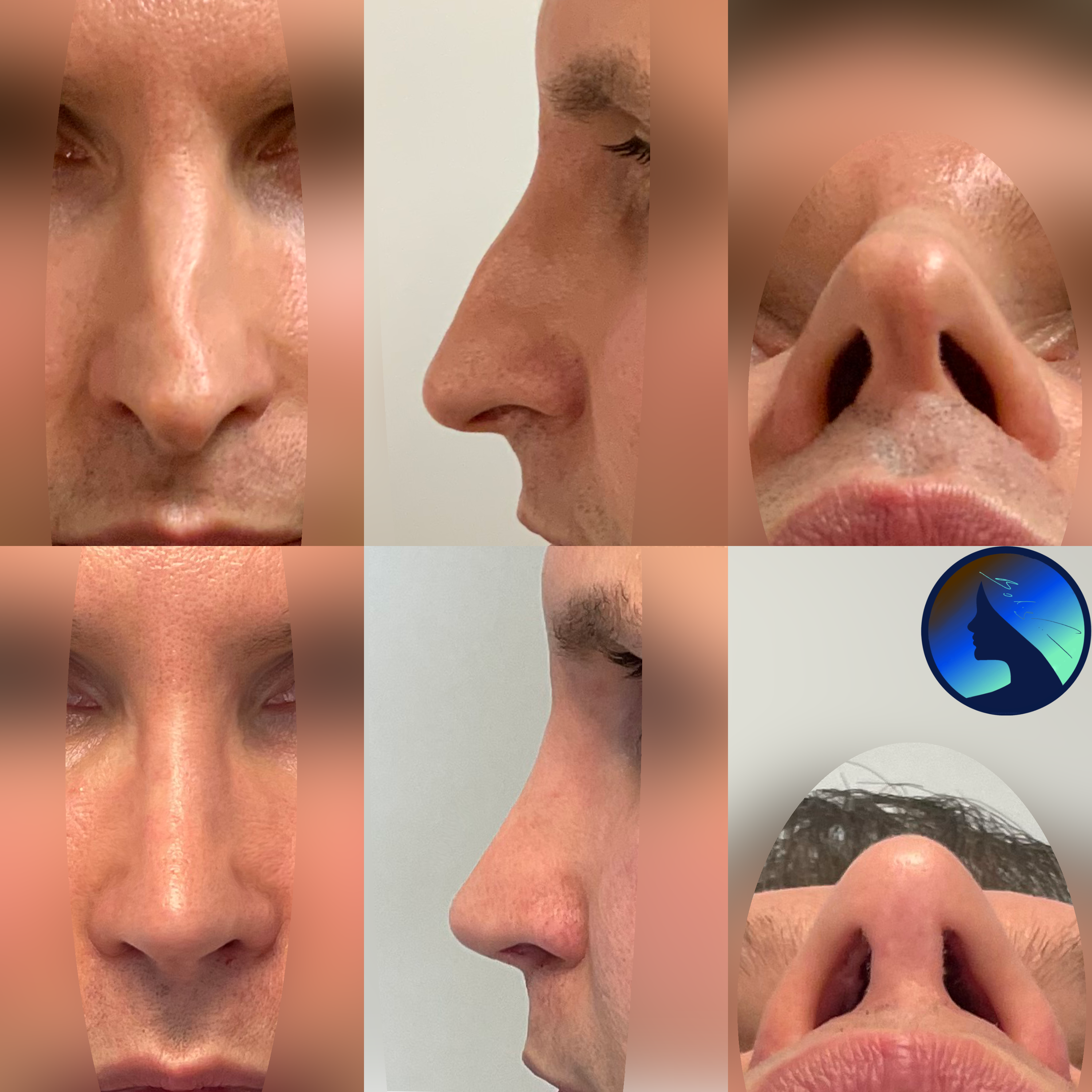 Nose Job in Men