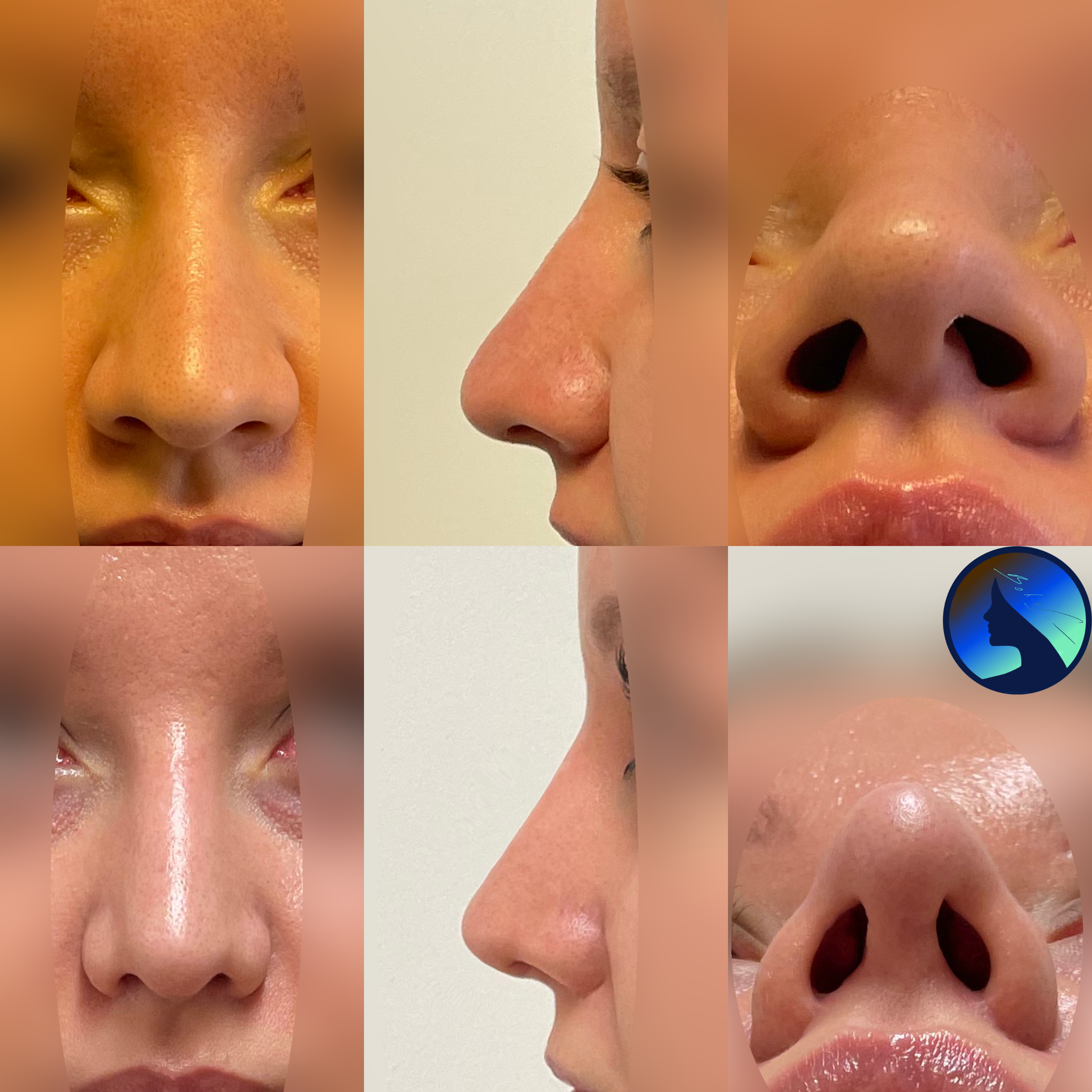 Nose Tip Correction and Trimming