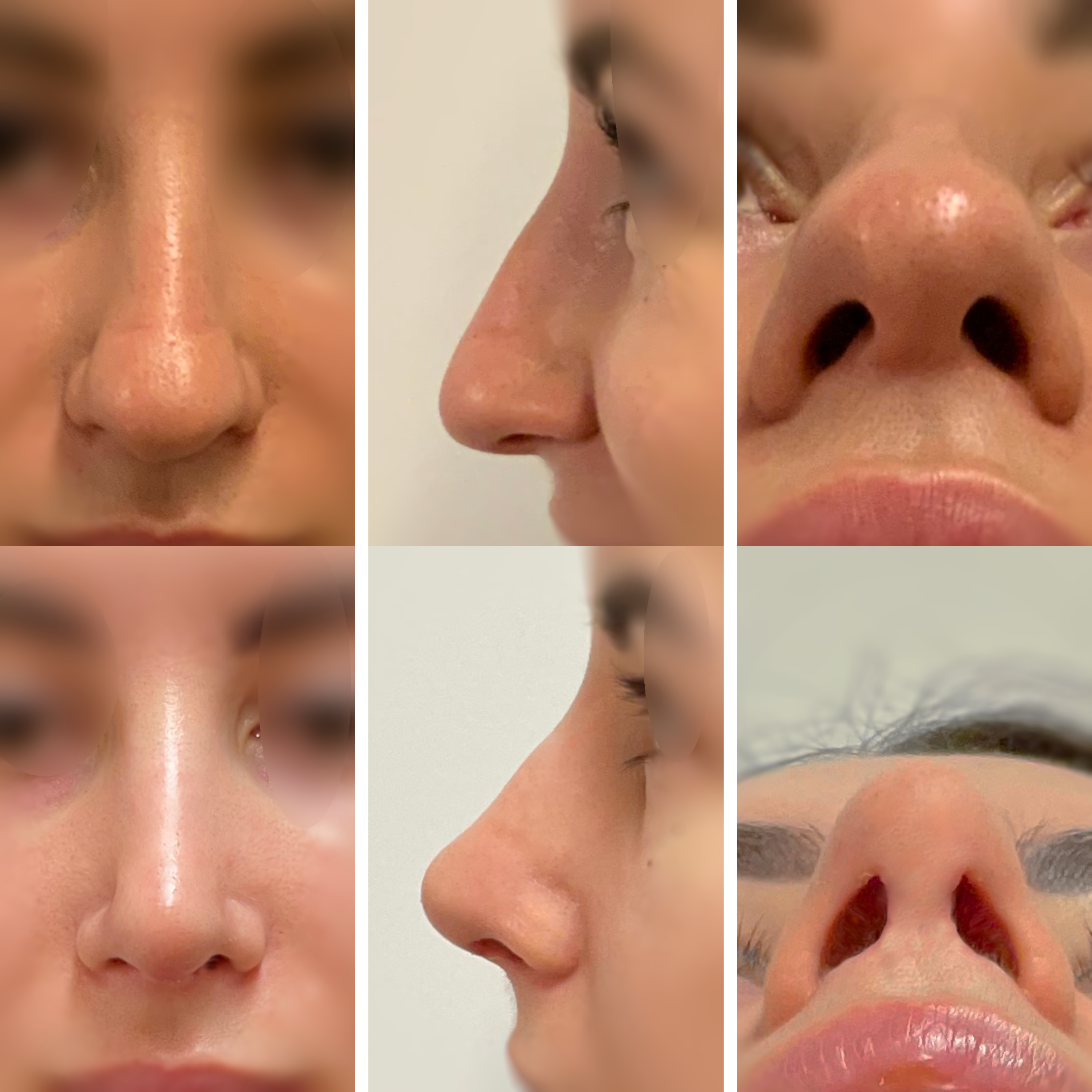 Wtórna korekta nosa