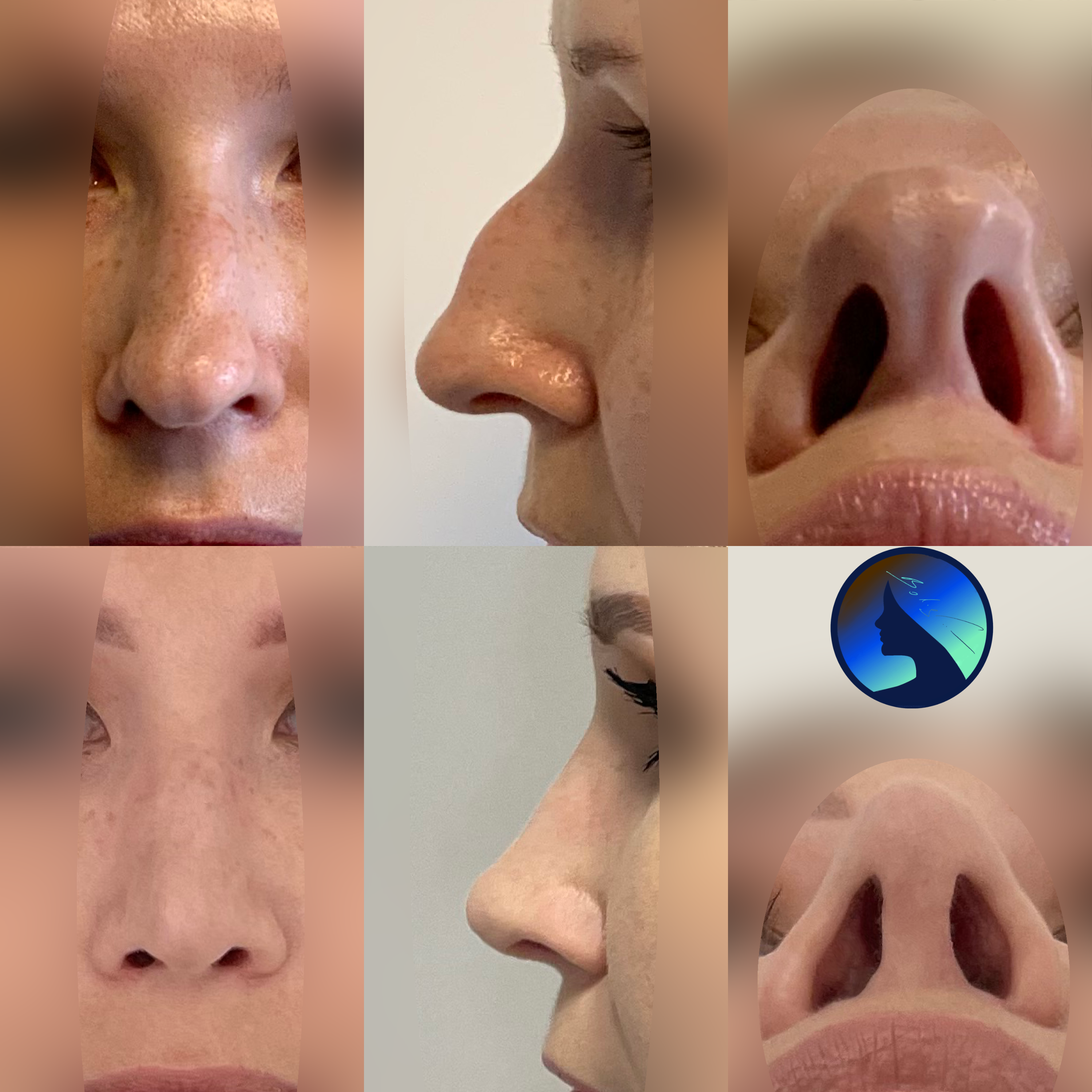 Wtórna korekta nosa