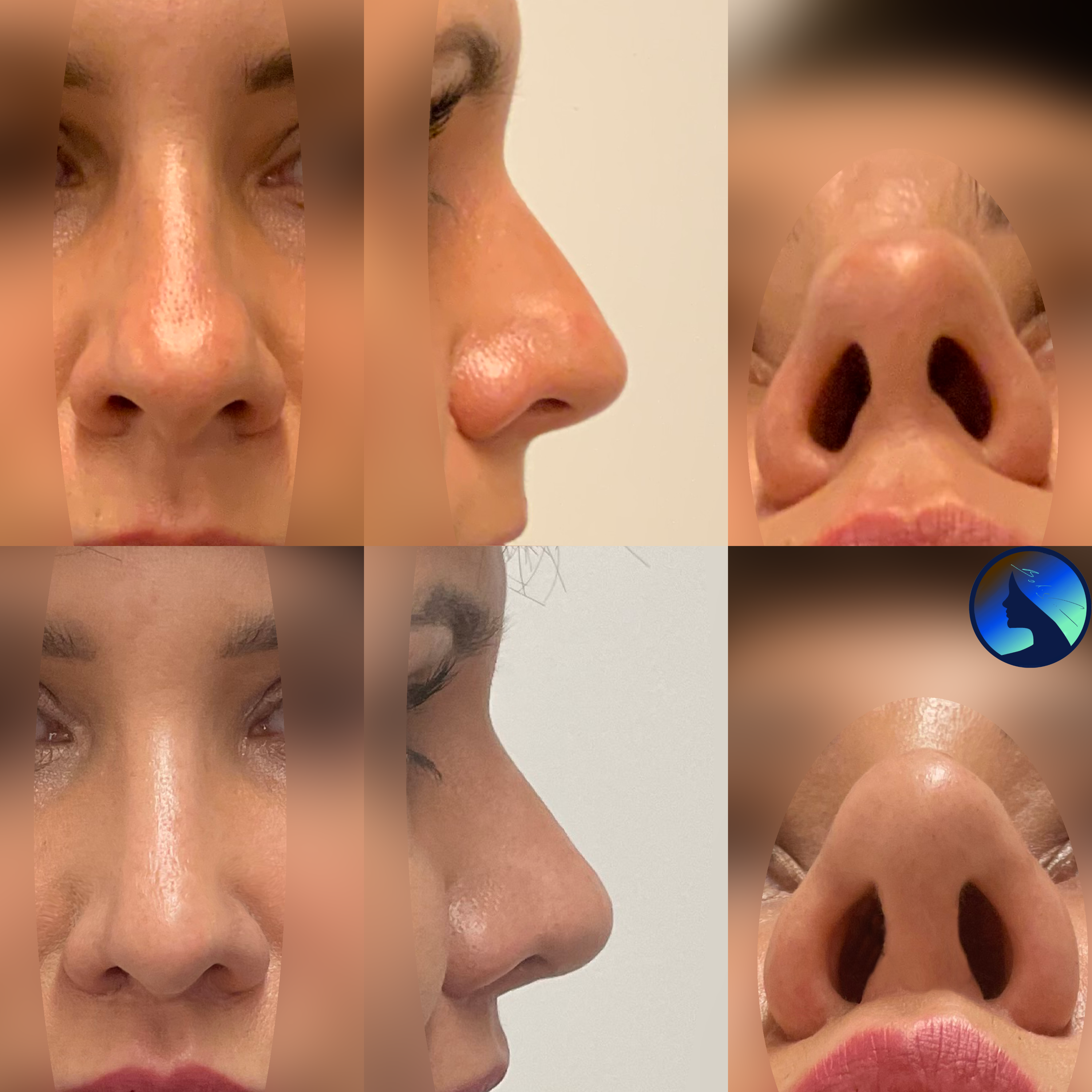 Wtórna korekta nosa