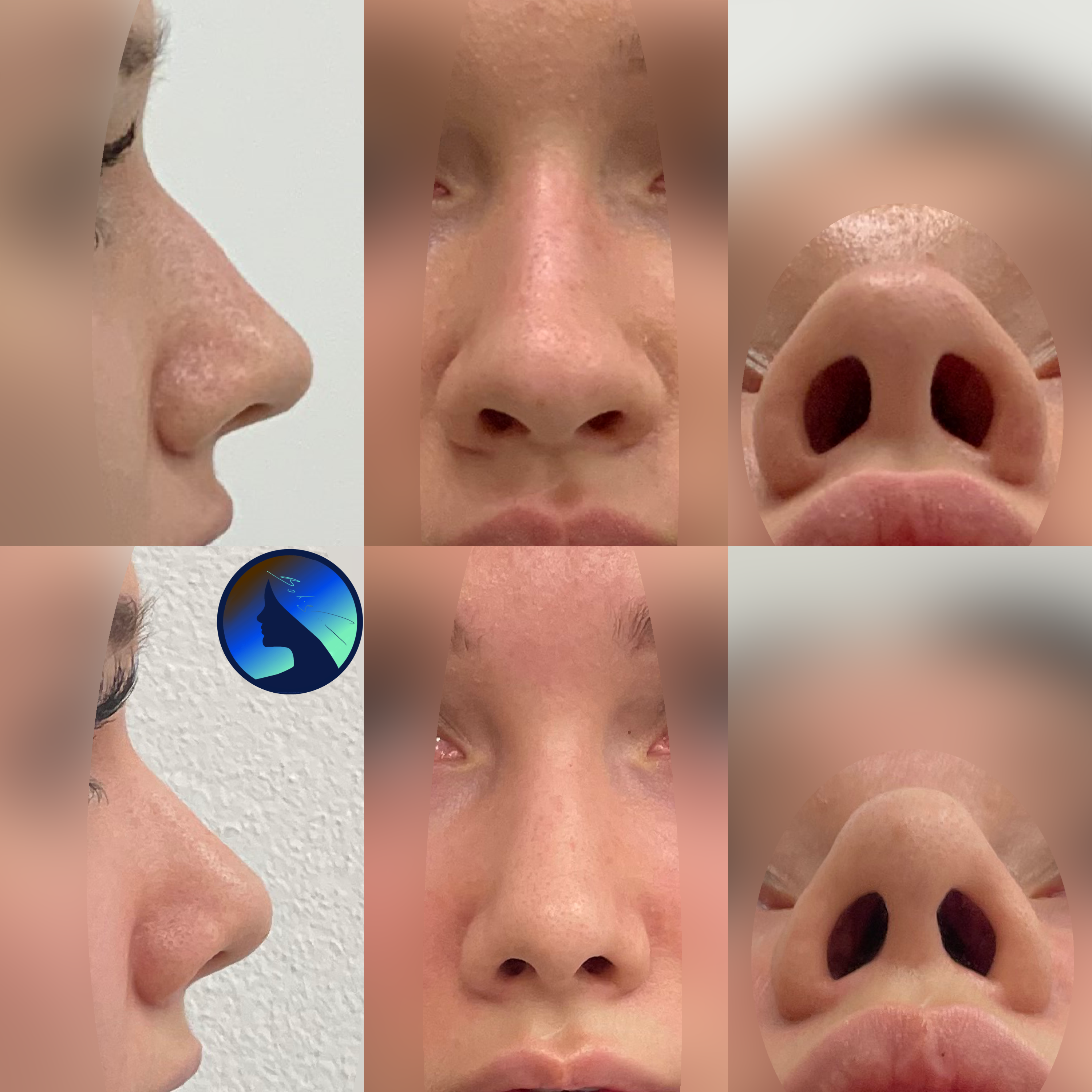 Wtórna korekta nosa