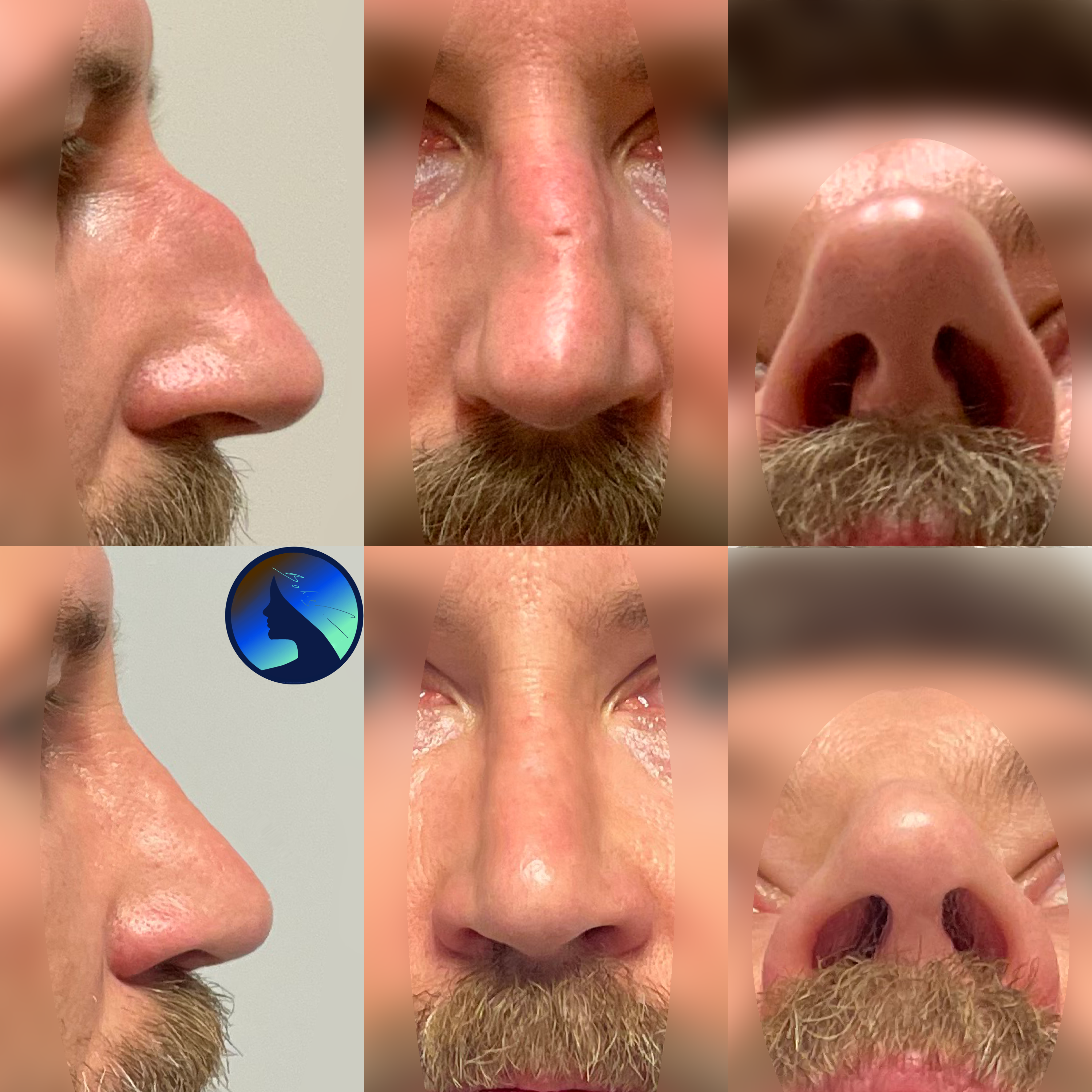 Wtórna korekta nosa