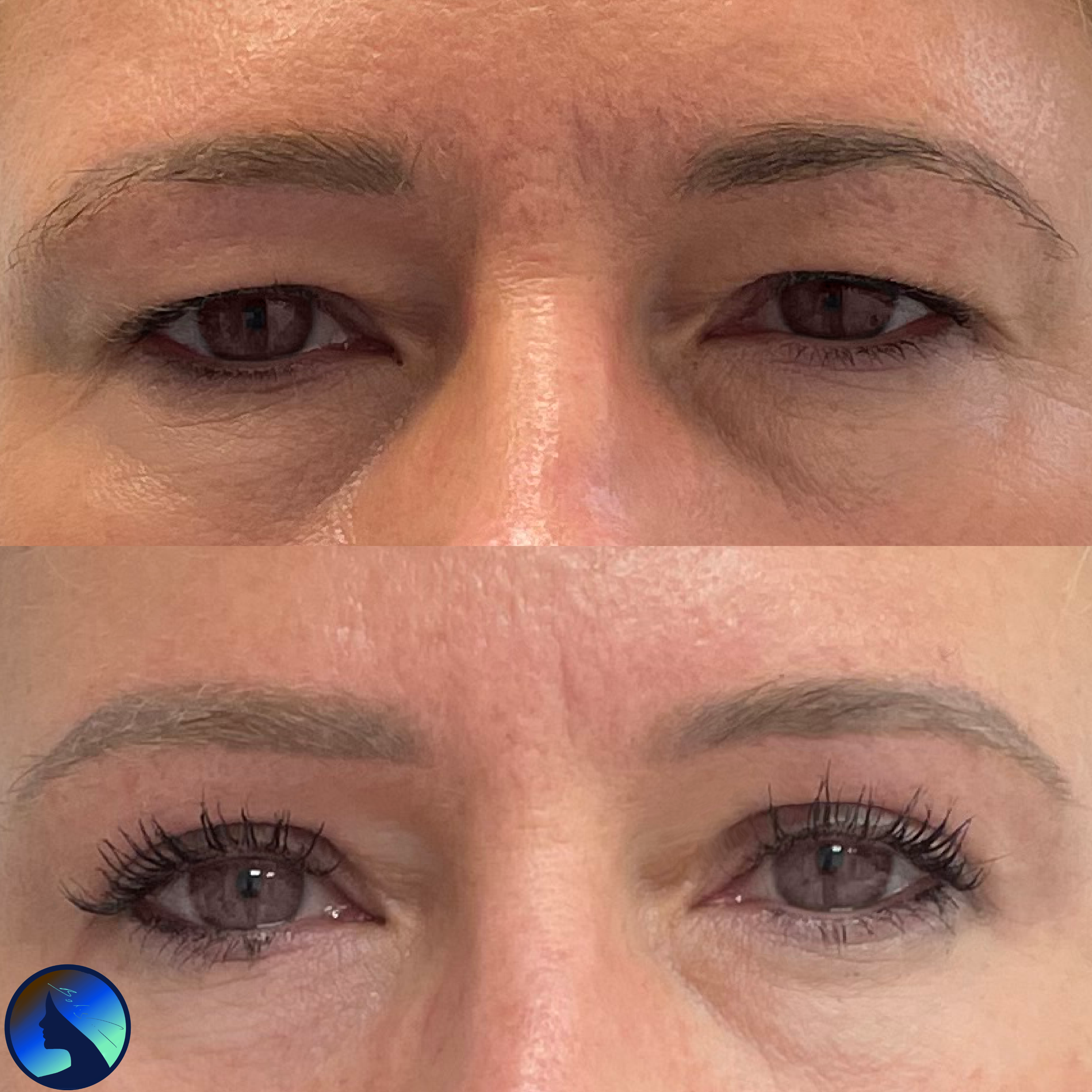 Plastyka powiek górnych z jednoczasną peksją brwi