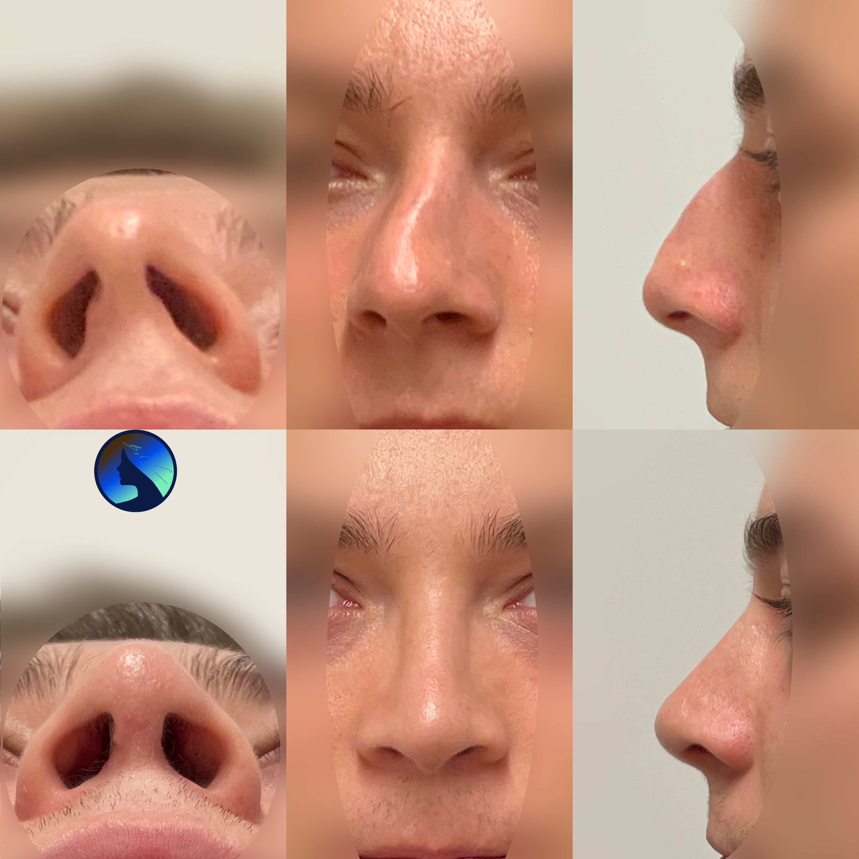 Posttraumatic primary Rhinoplasty