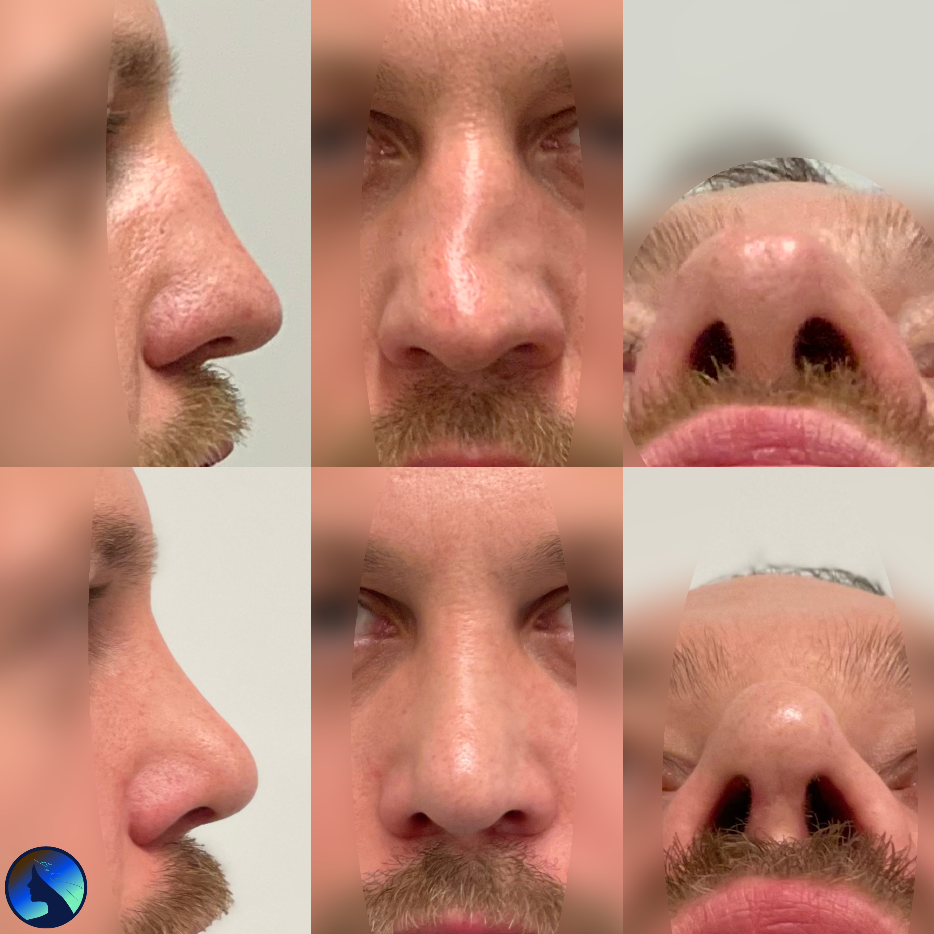 Posttraumatic rhinoplasty