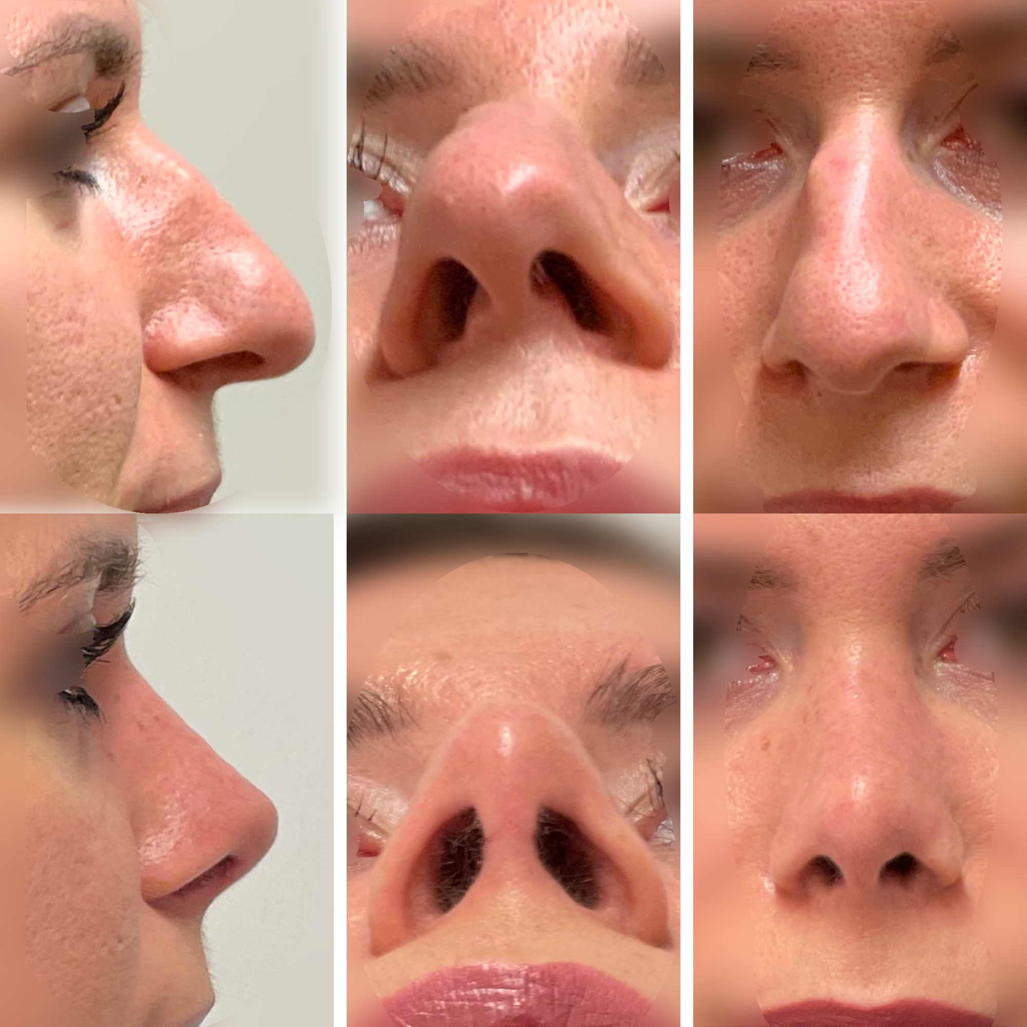 Prawdziwa całkowita korekcja nosa