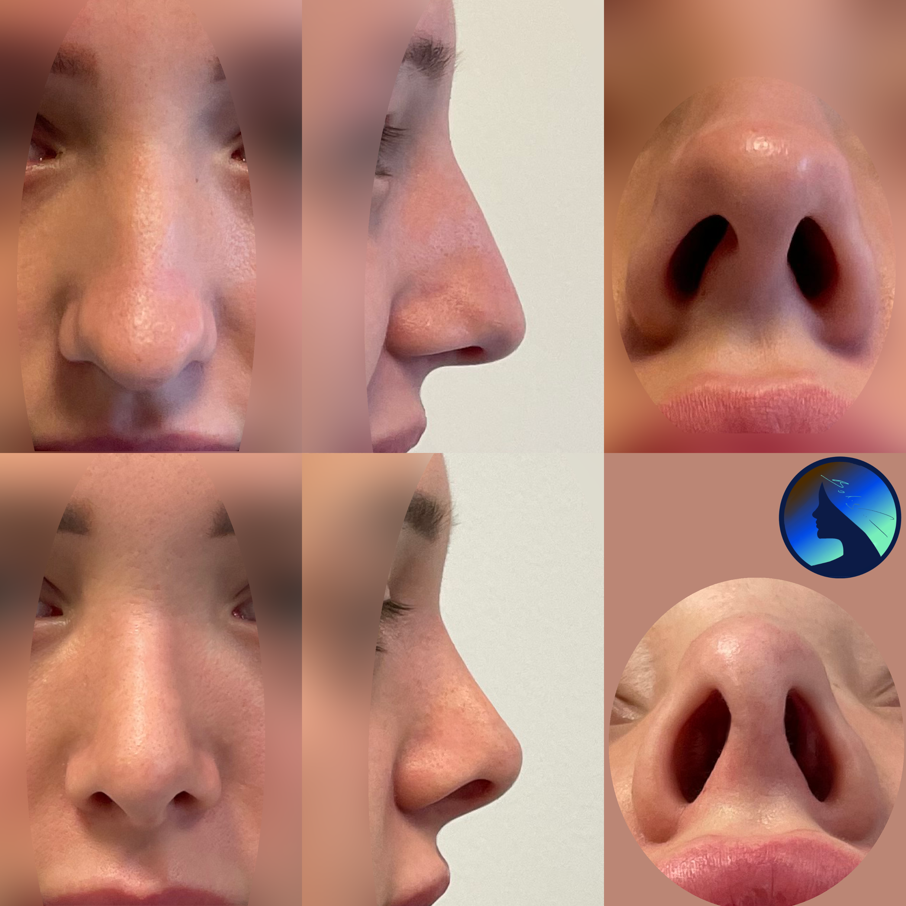Rhinoplasty Columella Strut