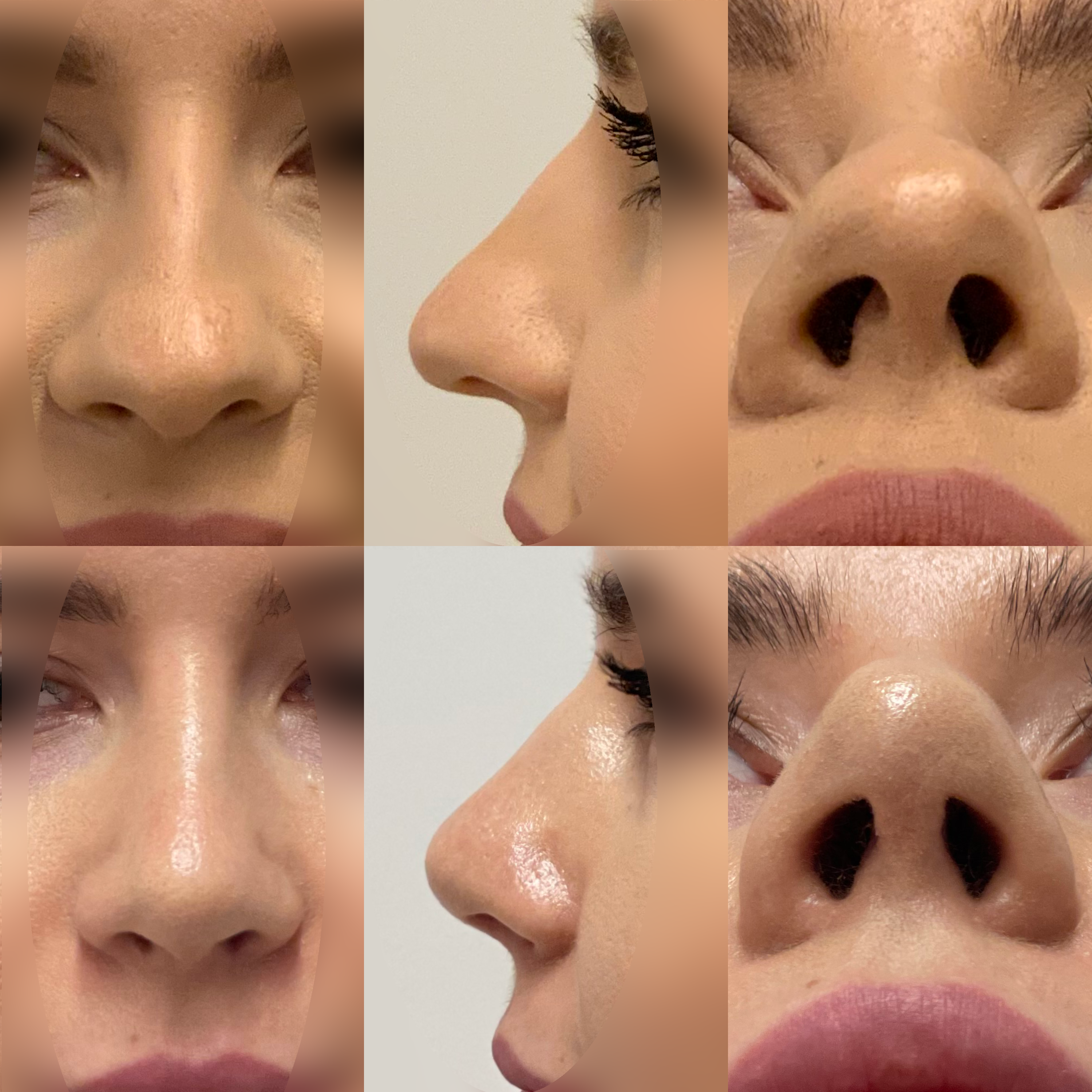 Wtórna korekta nosa