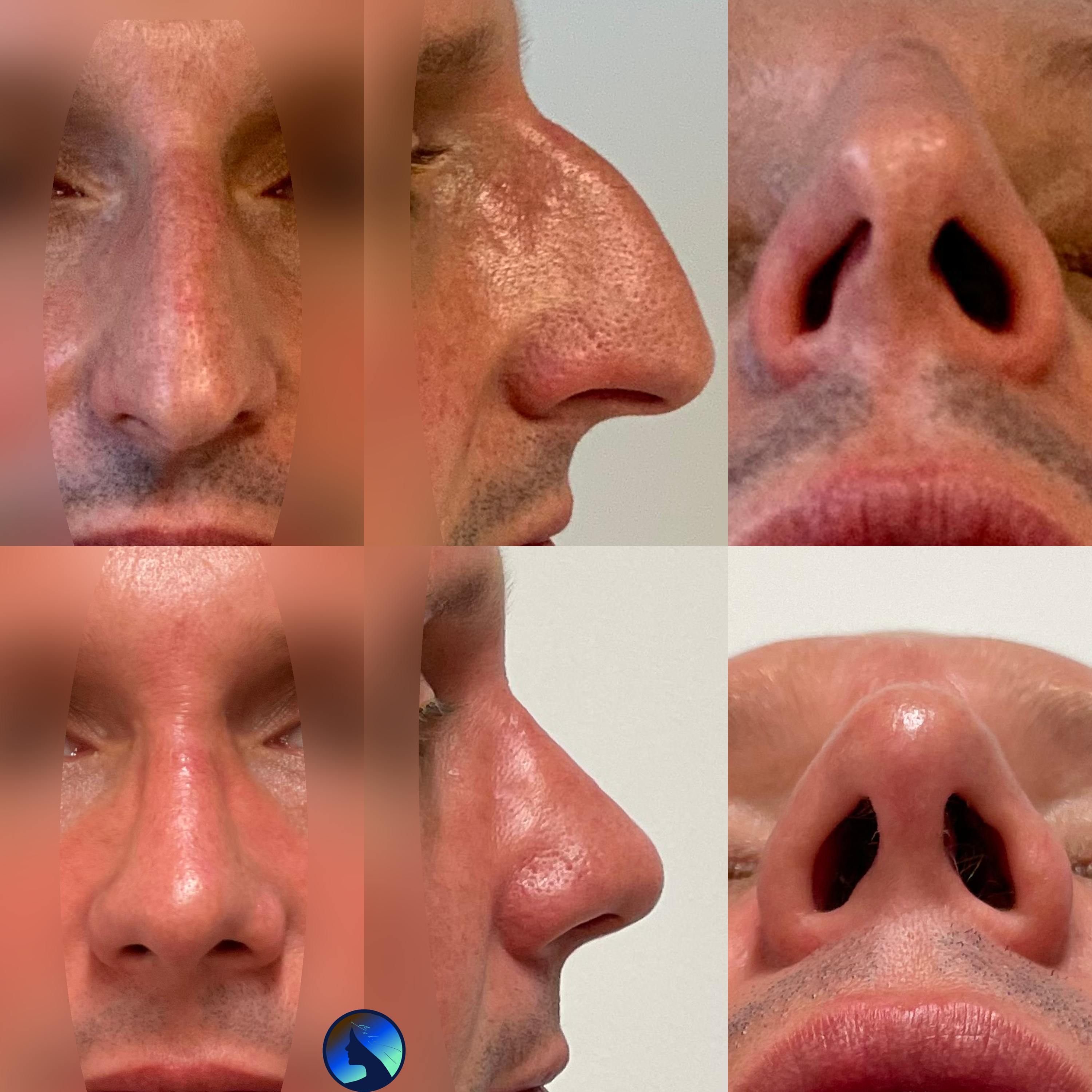 Rinoplastia despues de 1 ano