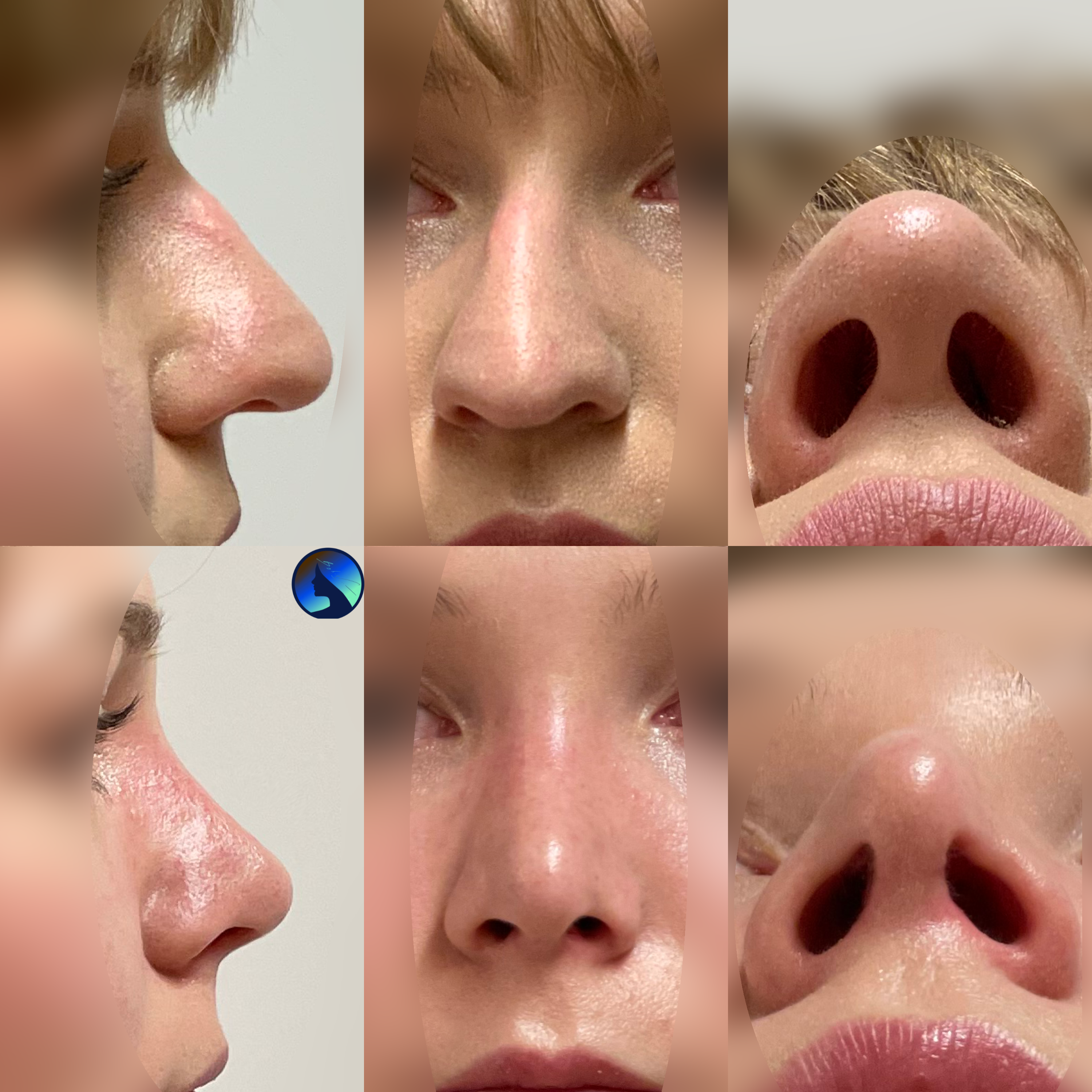 Wtórna korekta nosa