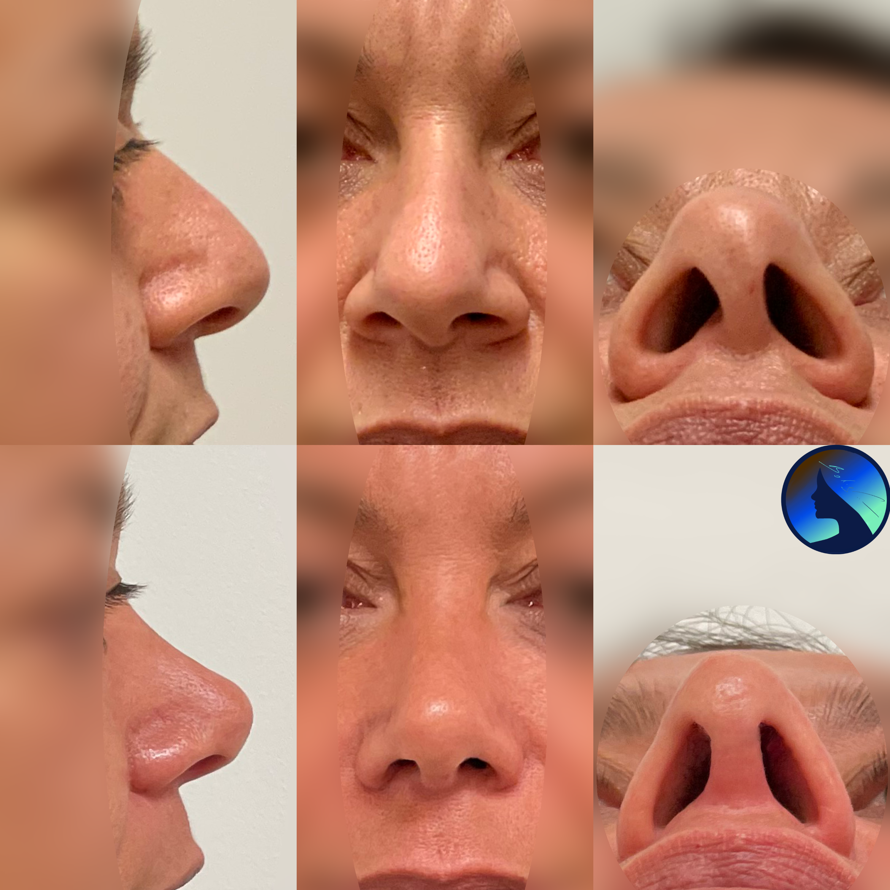 Semi-ethnic Rhinoplasty