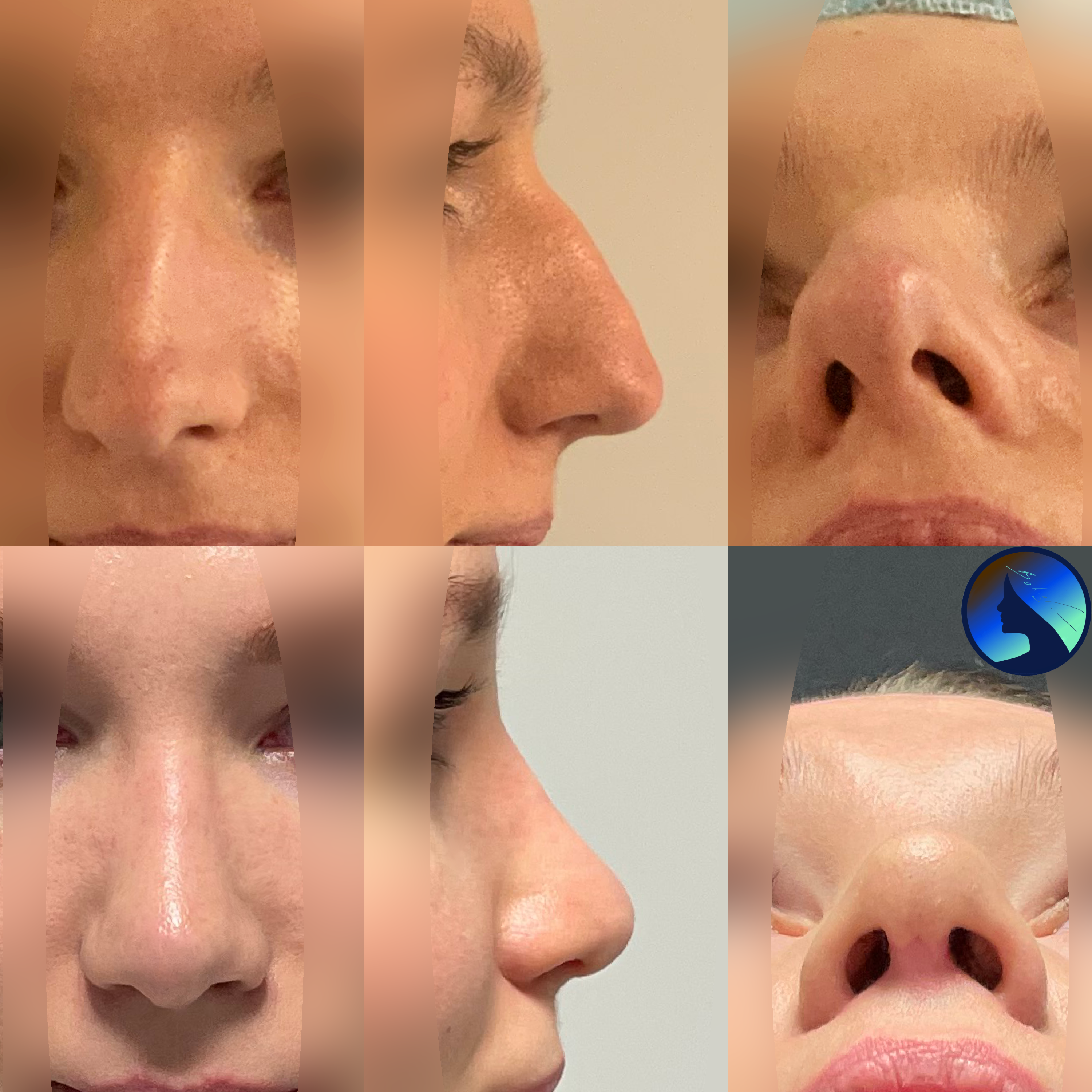 Septorhinoplasty before and after