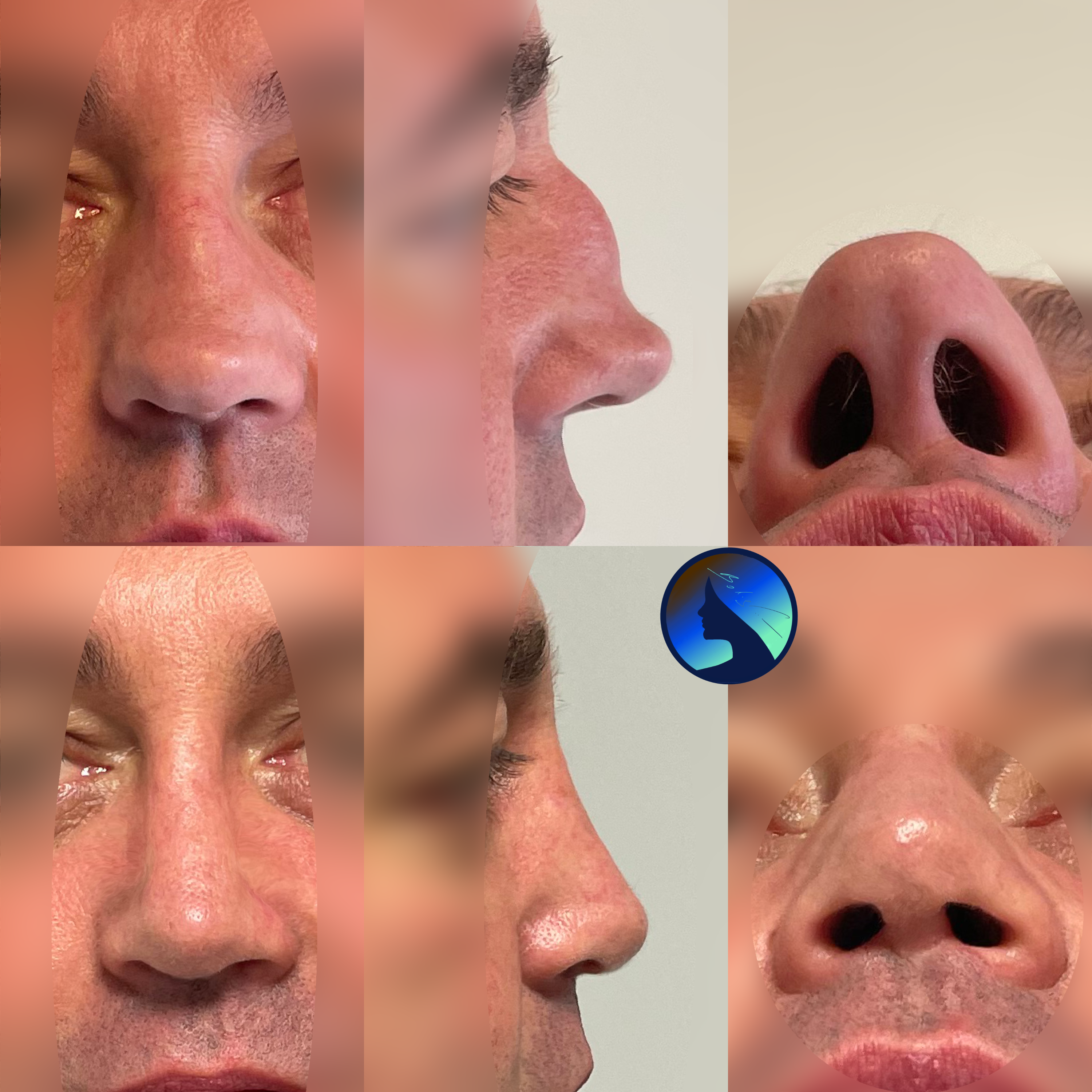 Wtórna korekta nosa