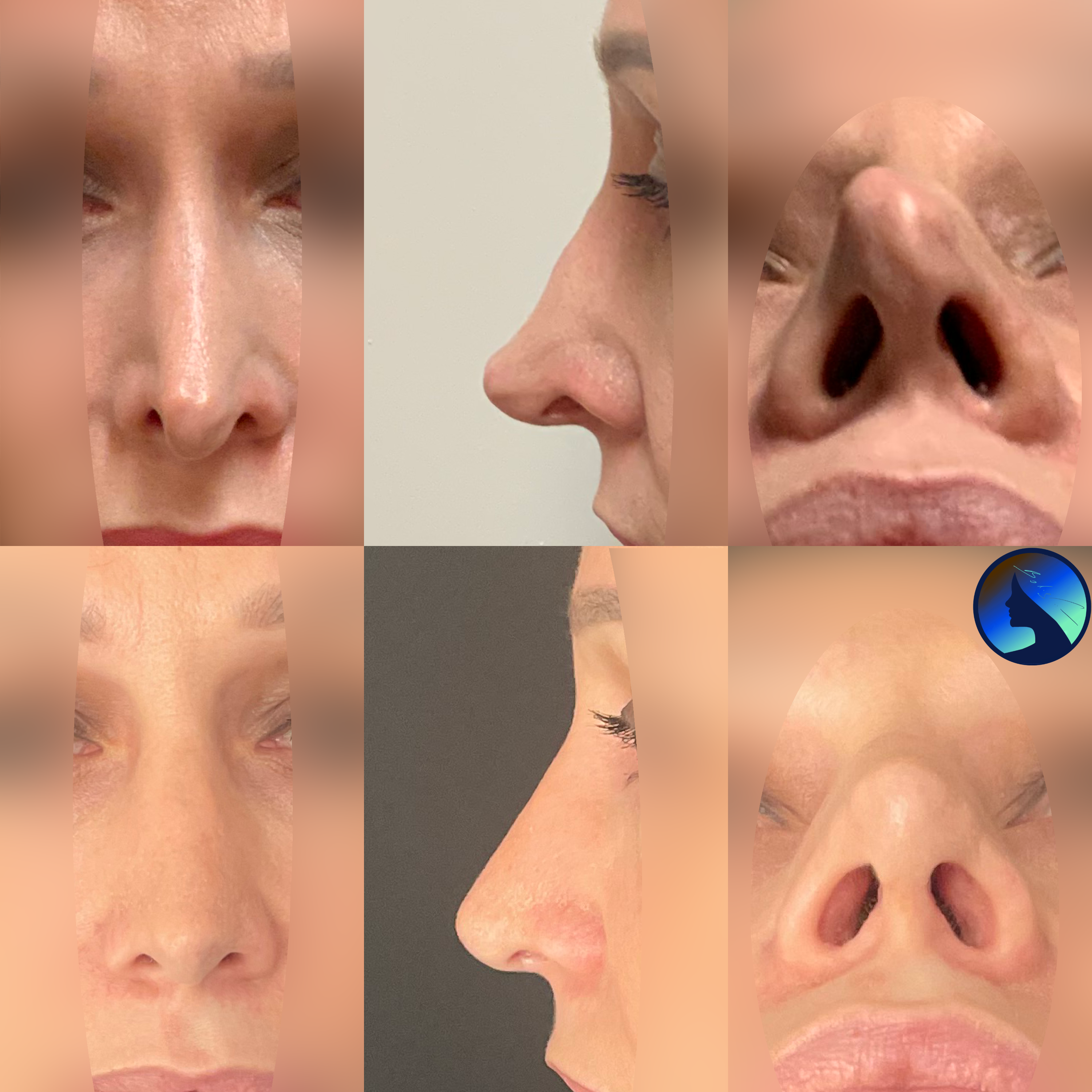 Wtórna korekta nosa