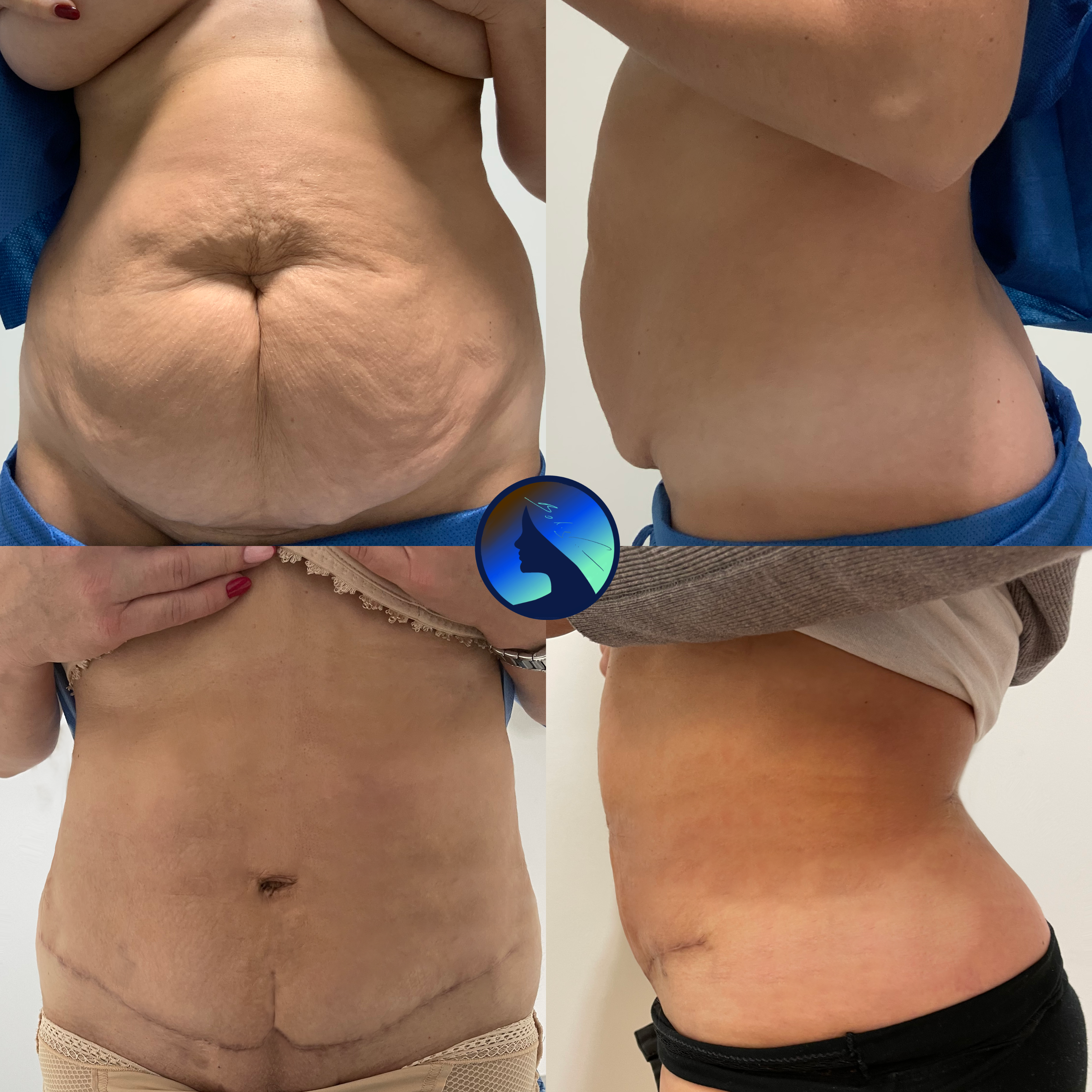 Short T abdominoplasty