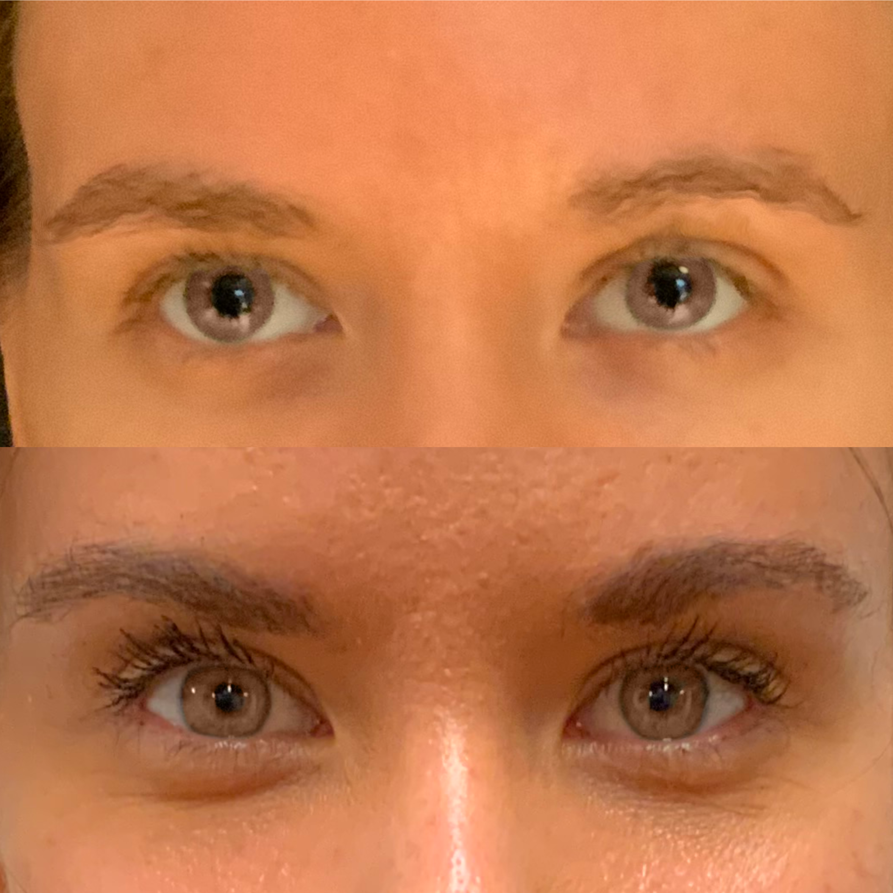 Skroniowy Lifting Brwi